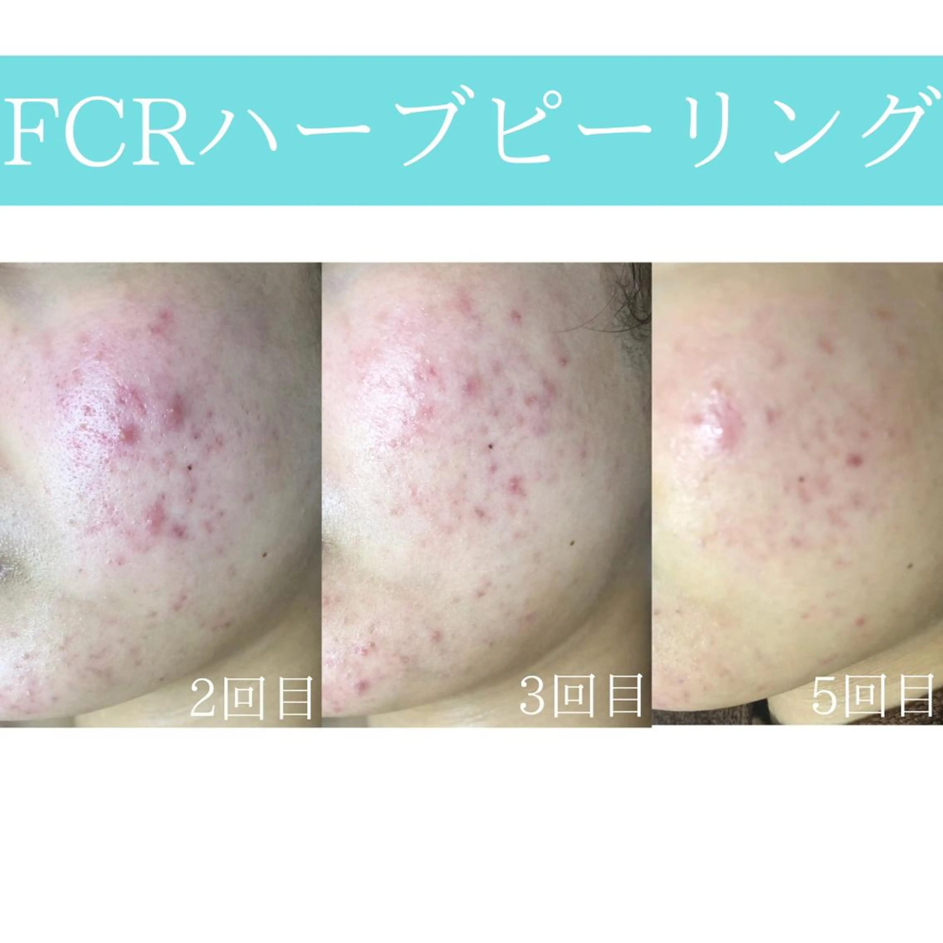 心斎橋痩身ダイエット 韓国.美容鍼.小顔のエステ・リラクイメージ