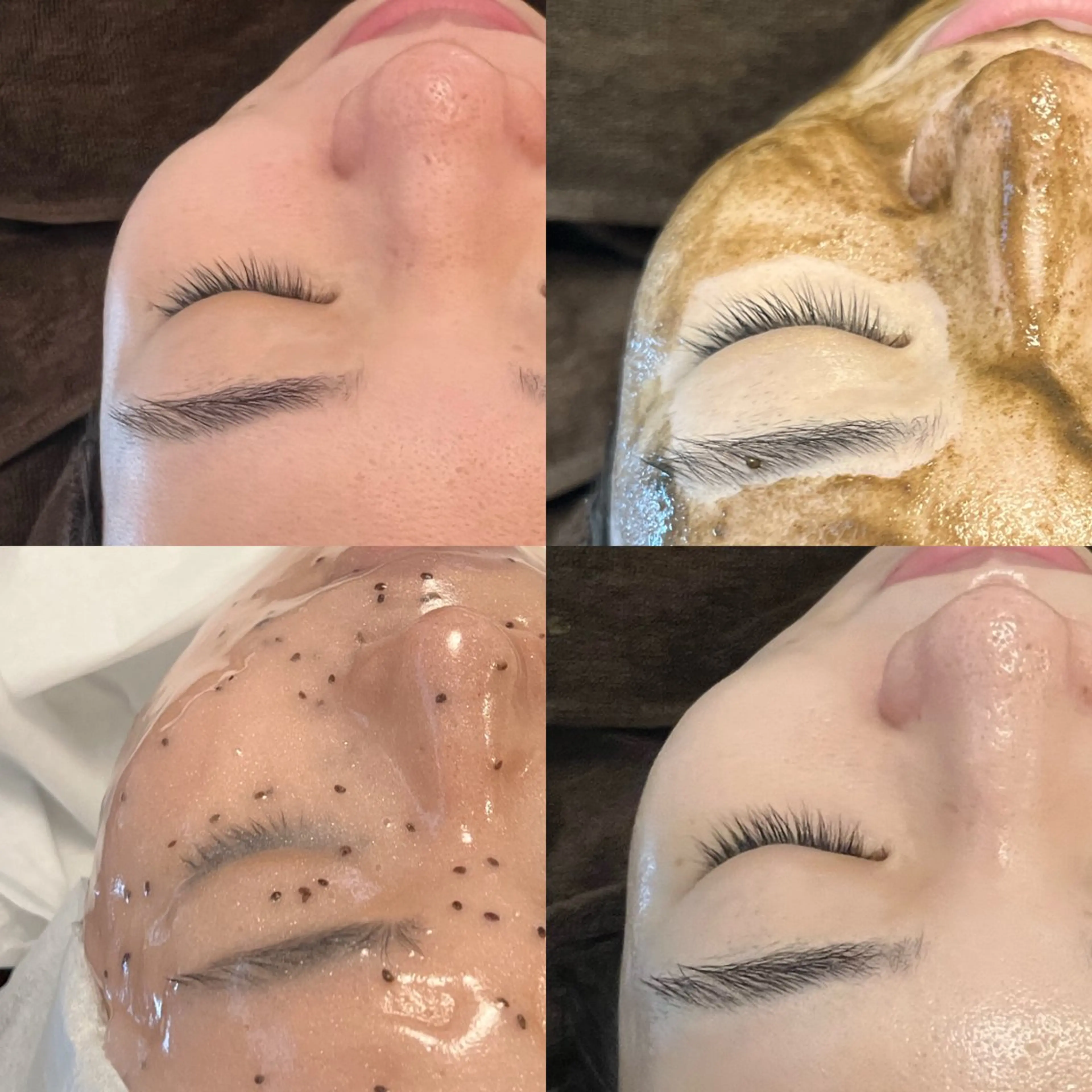 【ニキビケアCP☆】ハーブピーリング+毛穴洗浄+ハイドロジェリーマスク(モデリングマスク)の写真