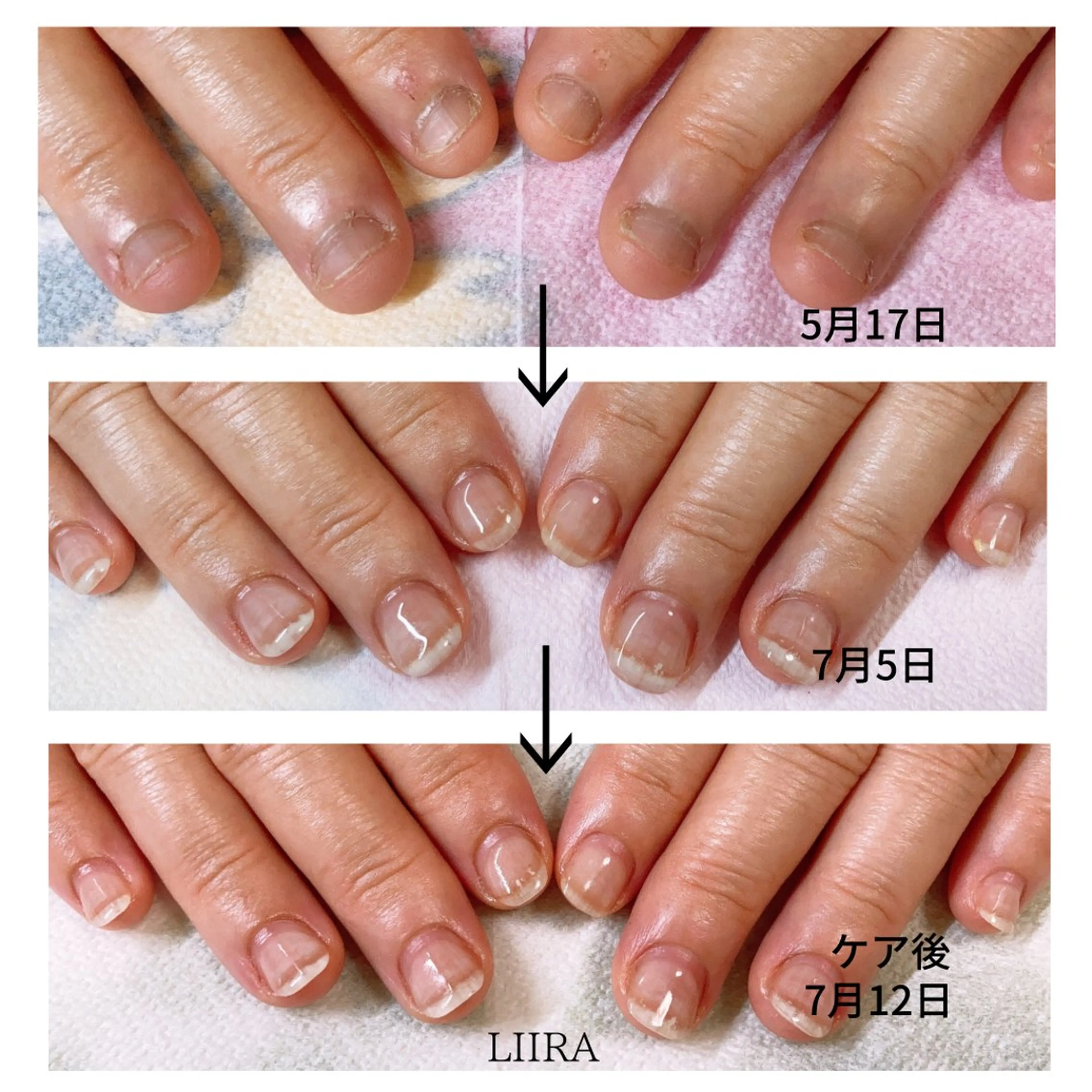 育爪‼️小さい爪、噛み癖、いじり癖、肌荒れなど肌や爪の悩み解決いたします✨理想の爪になれます＾＾の写真