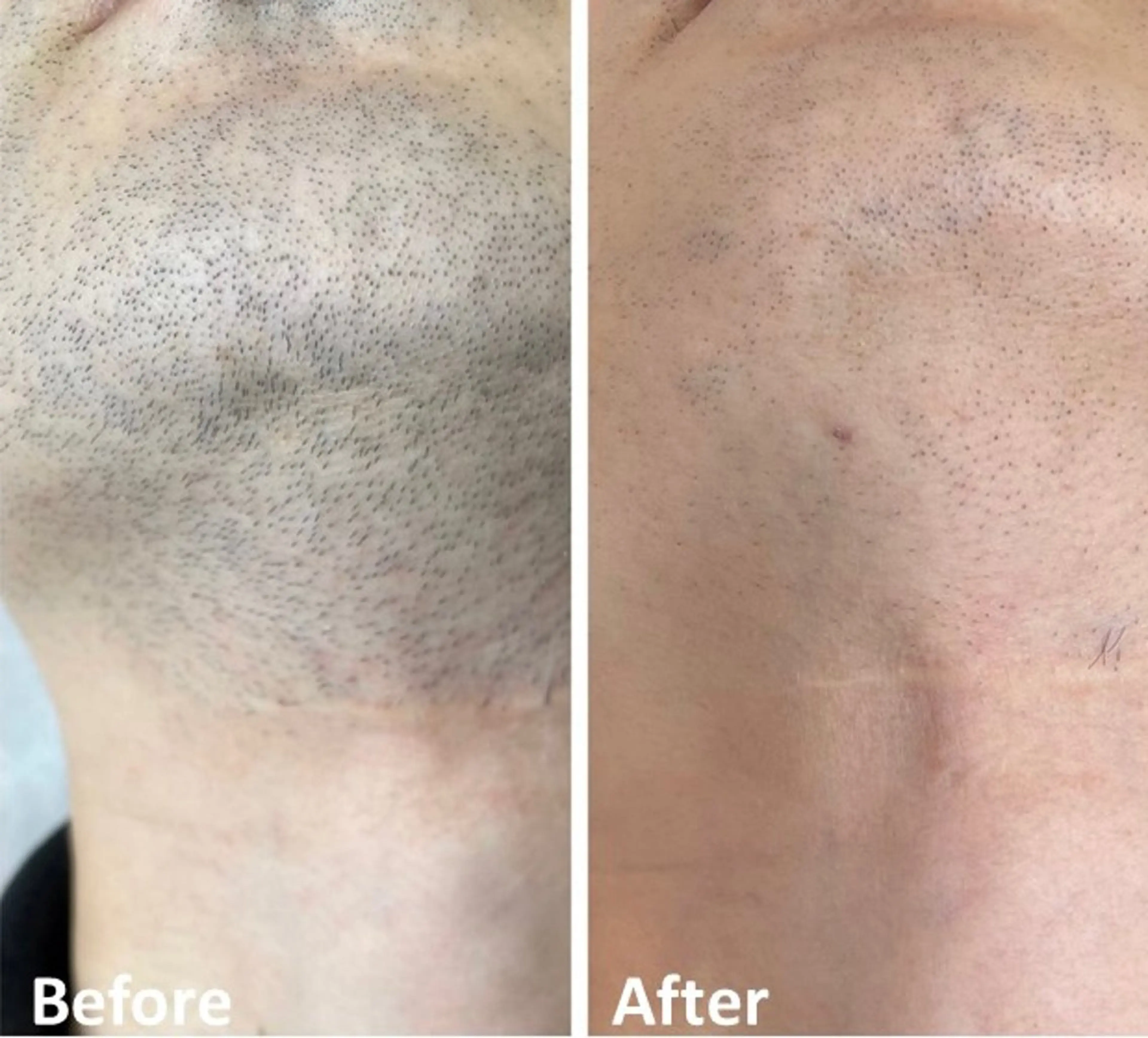 メンズ人気No.1✨お髭脱毛✨残したい部分は残しておけるポイント打ち可能👍の写真