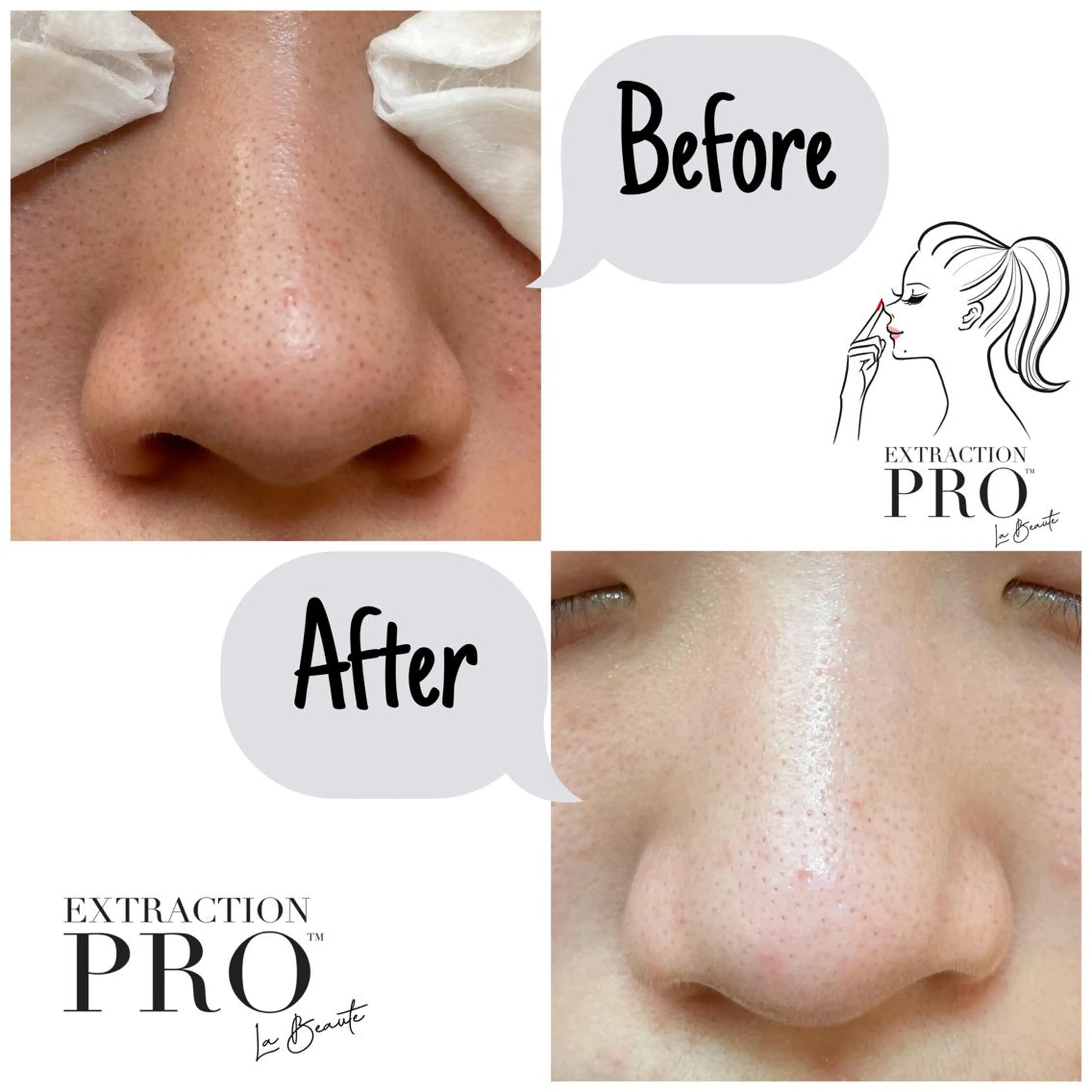 SNSで話題の毛穴エクストラクションプロ‼︎初回特別割引♪いちご鼻撃退!長年の毛穴のお悩み改善★の写真