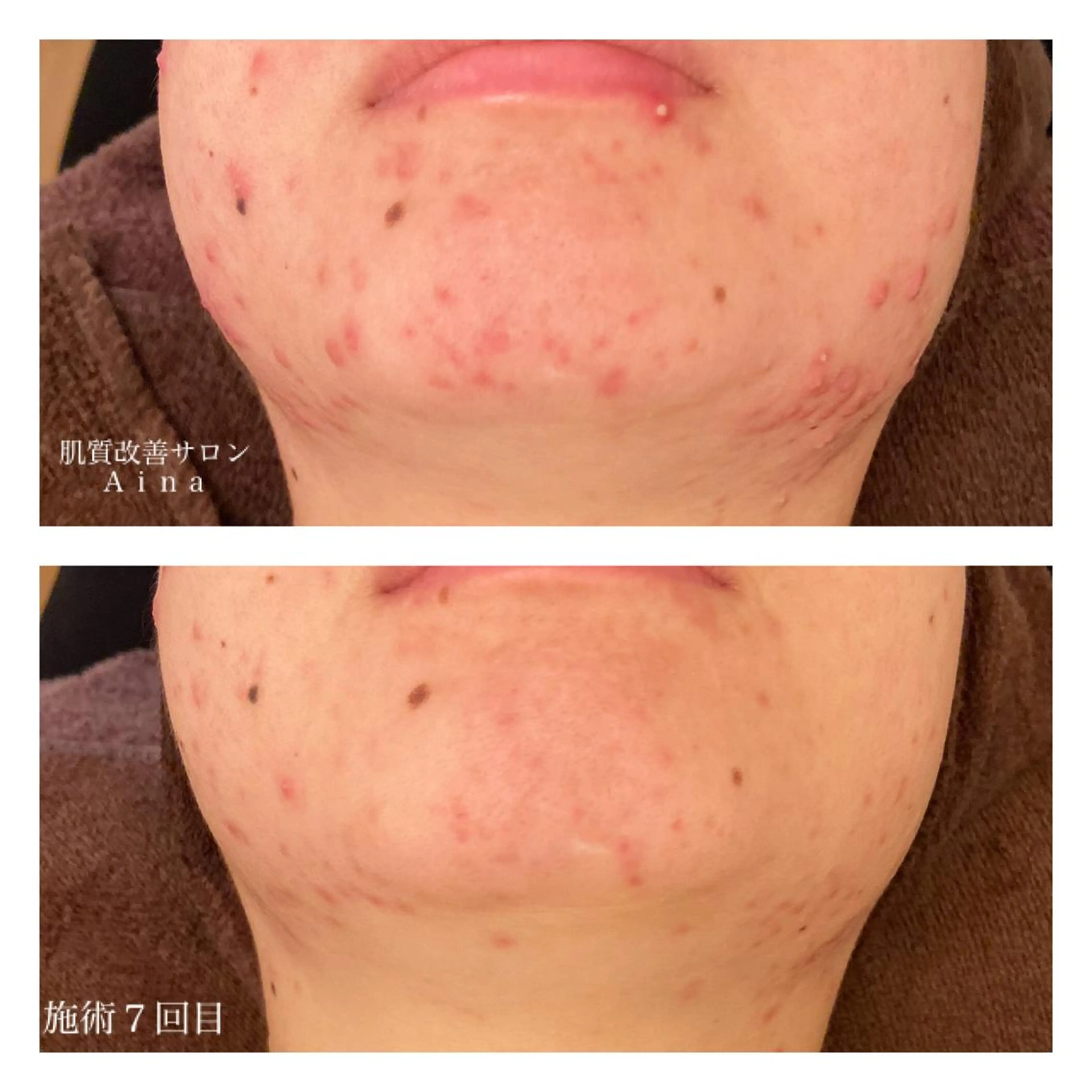 ミディアム カラー パーマ ヘアアレンジ メンズ キッズ ネイル マツエク・マツパ エステ リラク ニキビ跡専門サロン Ａｉｎａのエステ・リラクイメージ