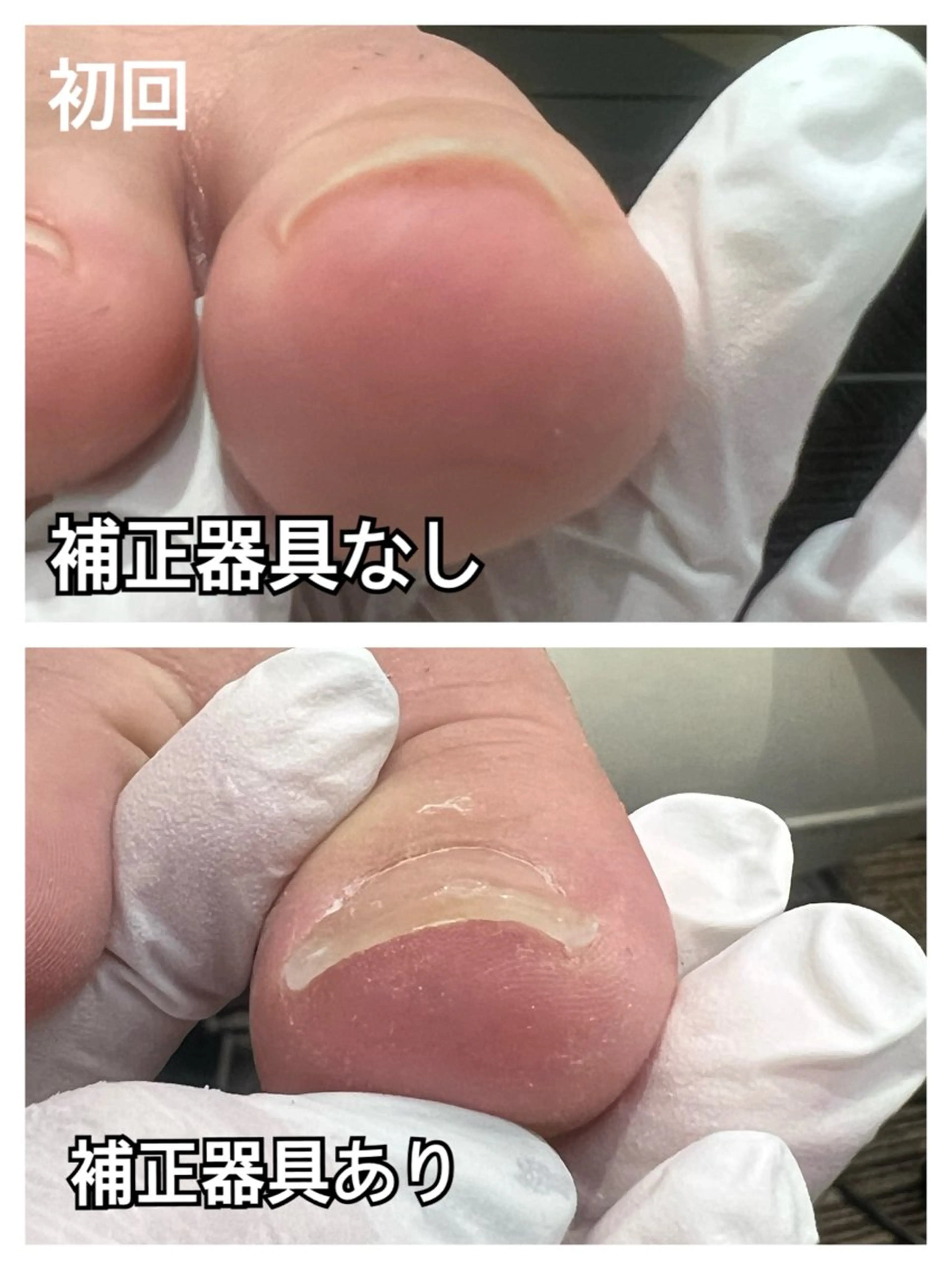 ⭐️全員対象⭐️巻き爪補正（軽度） ¥7,700の写真