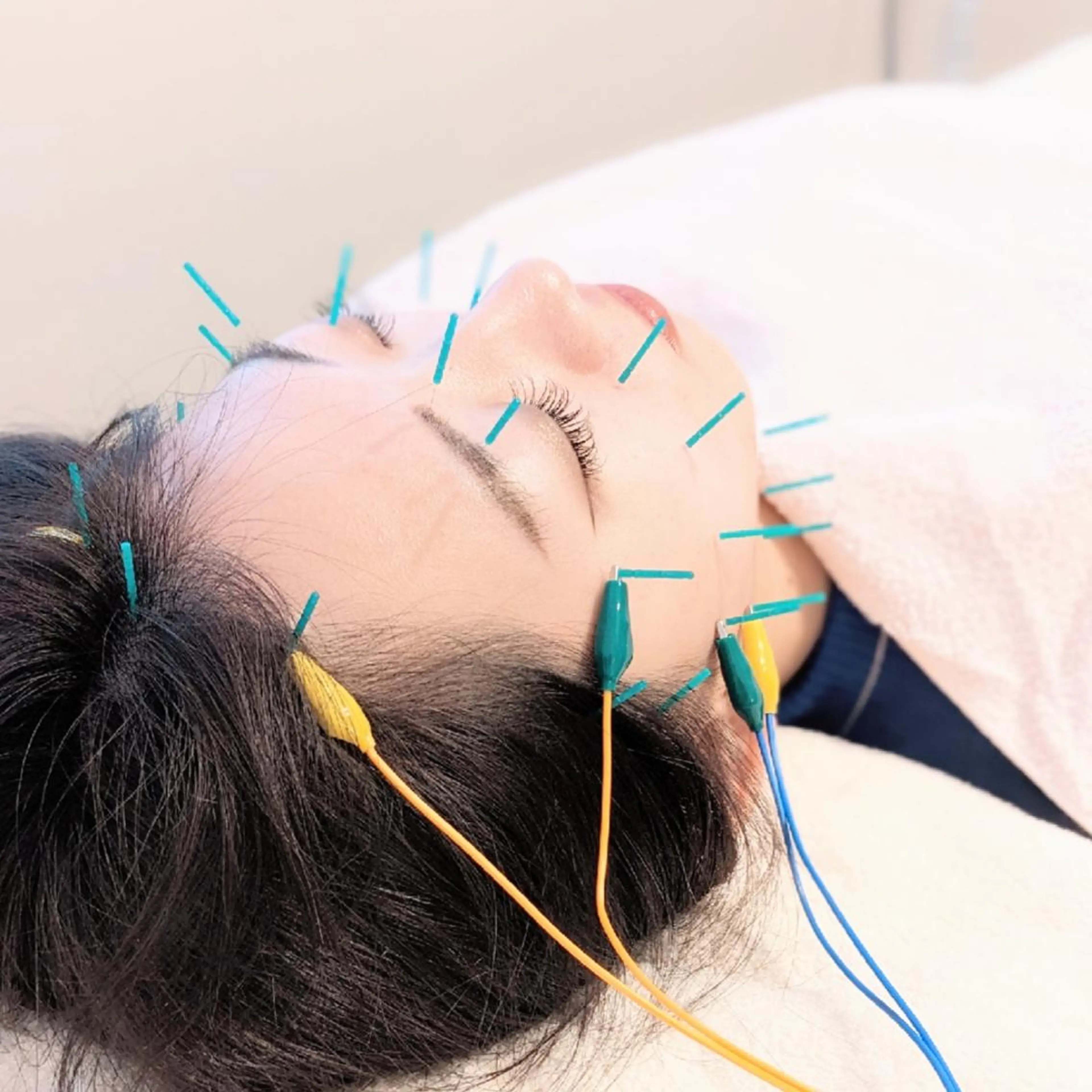 【肌質ケアに特化】さよならゴワゴワ肌👋透明感あるツヤたま肌美容鍼♡カウンセリング込60分の写真