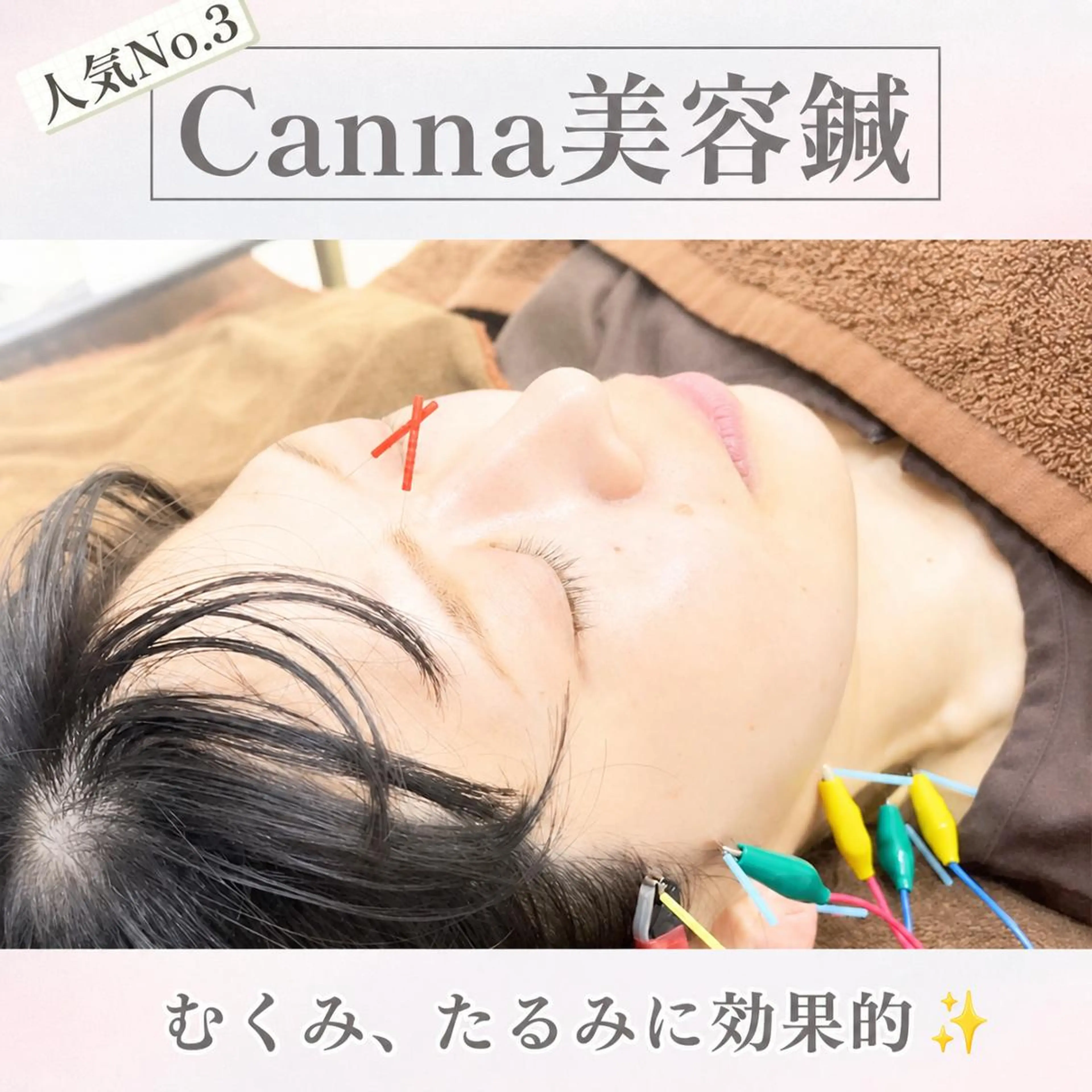 【美容鍼・小顔鍼】 鍼灸師　森原拓磨のエステ・リラクイメージ