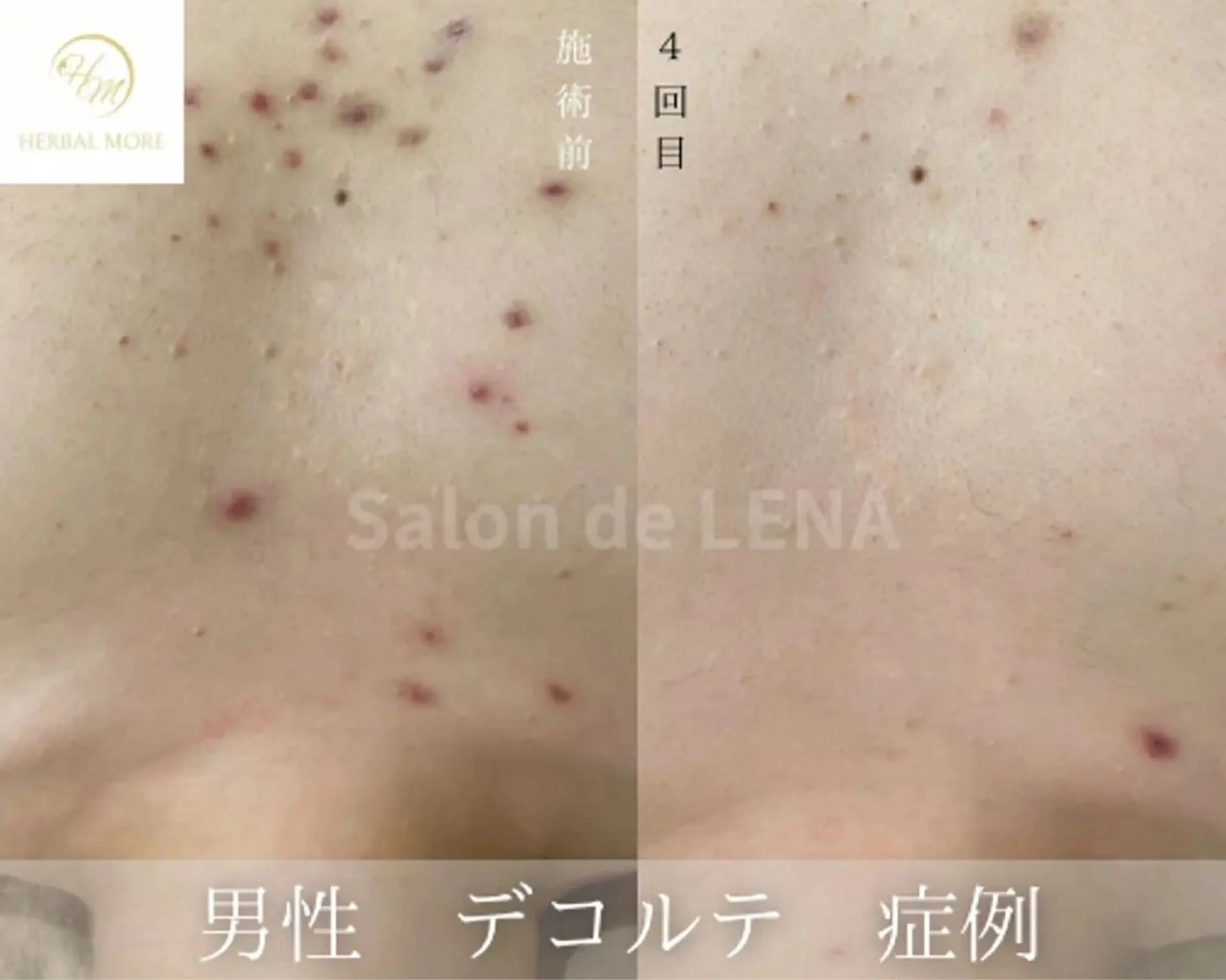 【デコルテハーブピーリング/剥離有•無】ニキビケア、色素◯着、毛穴、サメ肌、ニキビあとの写真