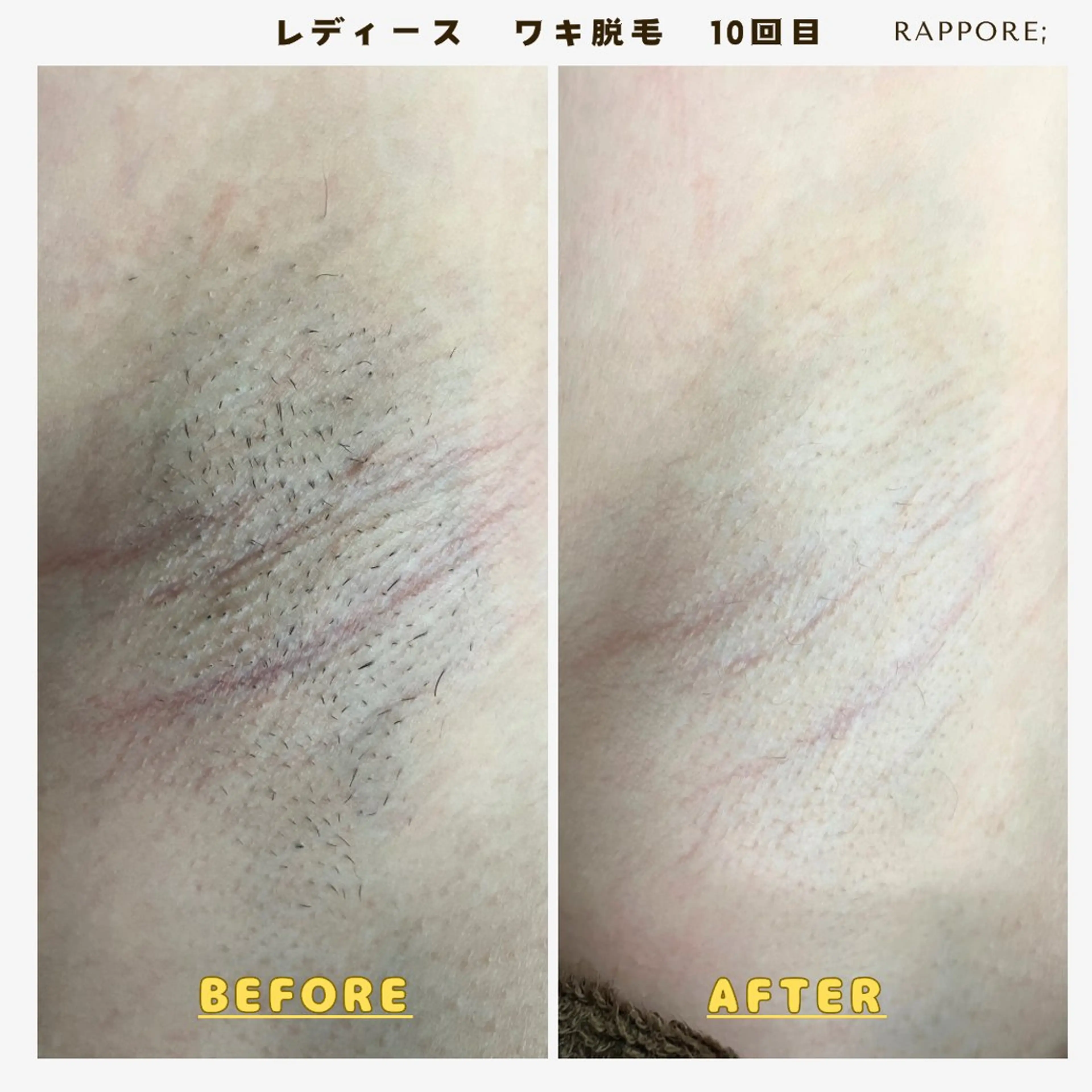 脱毛 Rappore; 心斎橋　みずきのエステ・リラクイメージ