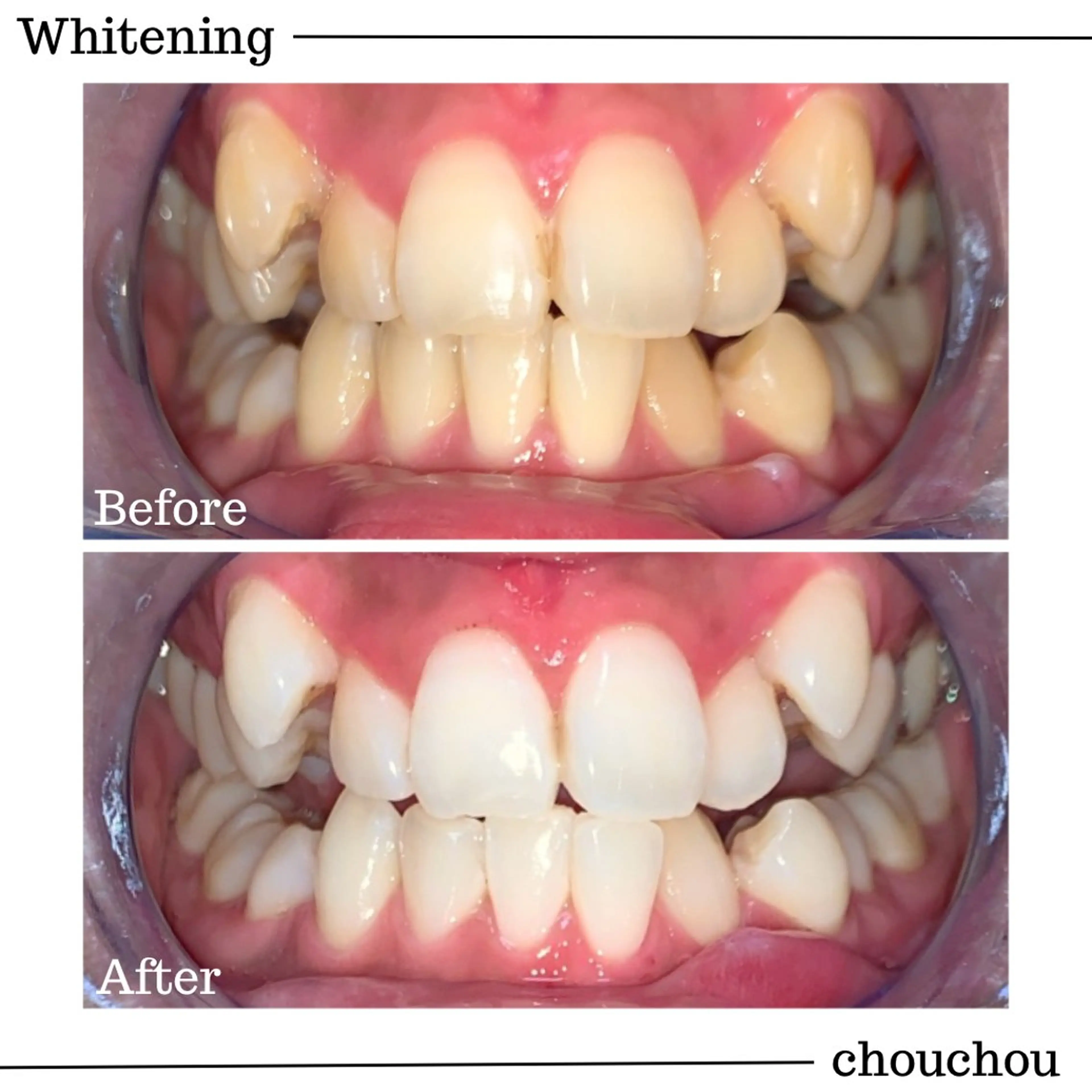 【初回限定】医療機関提携ジェルホワイトニングの写真