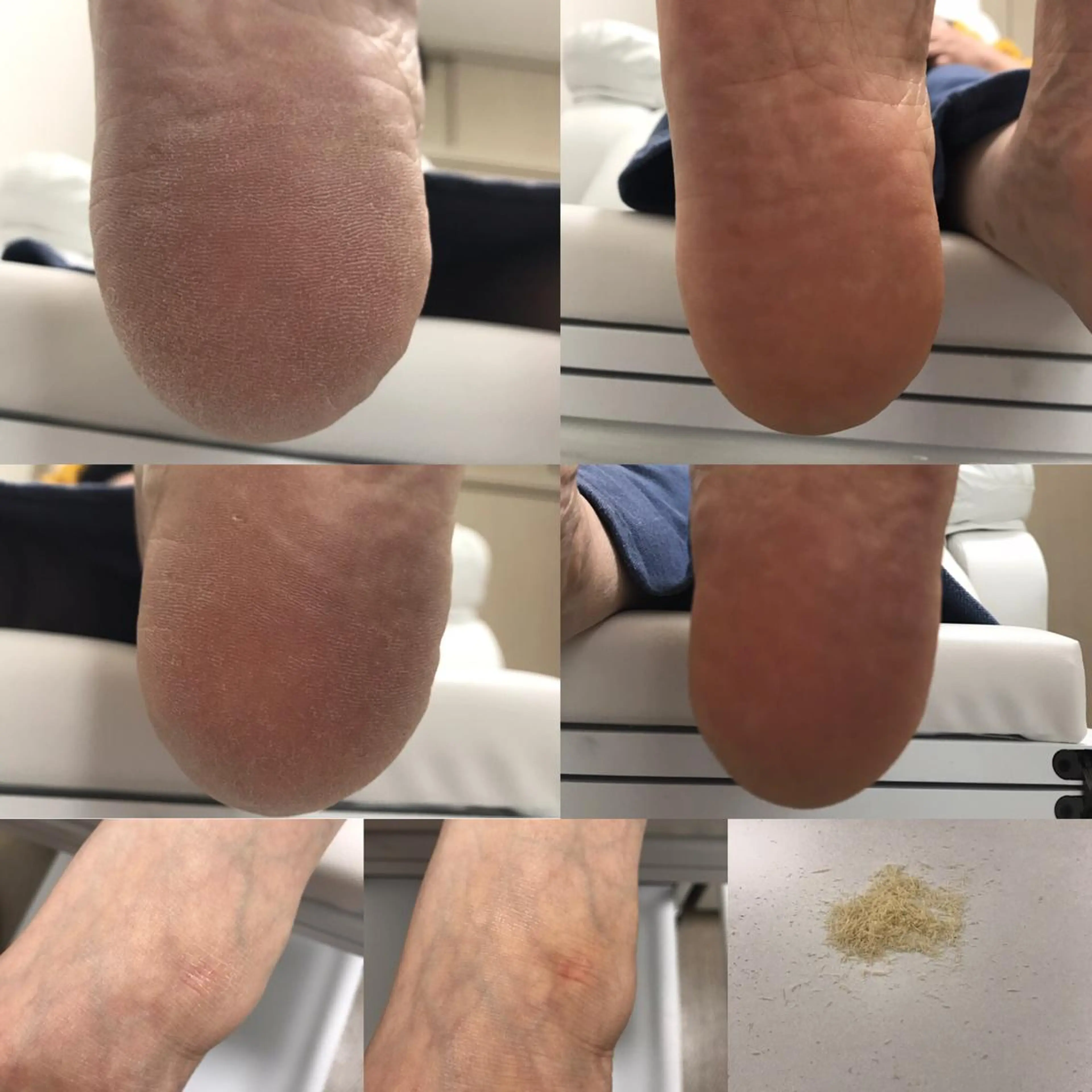 初回フット角質ケア通常3850円→2750円の写真