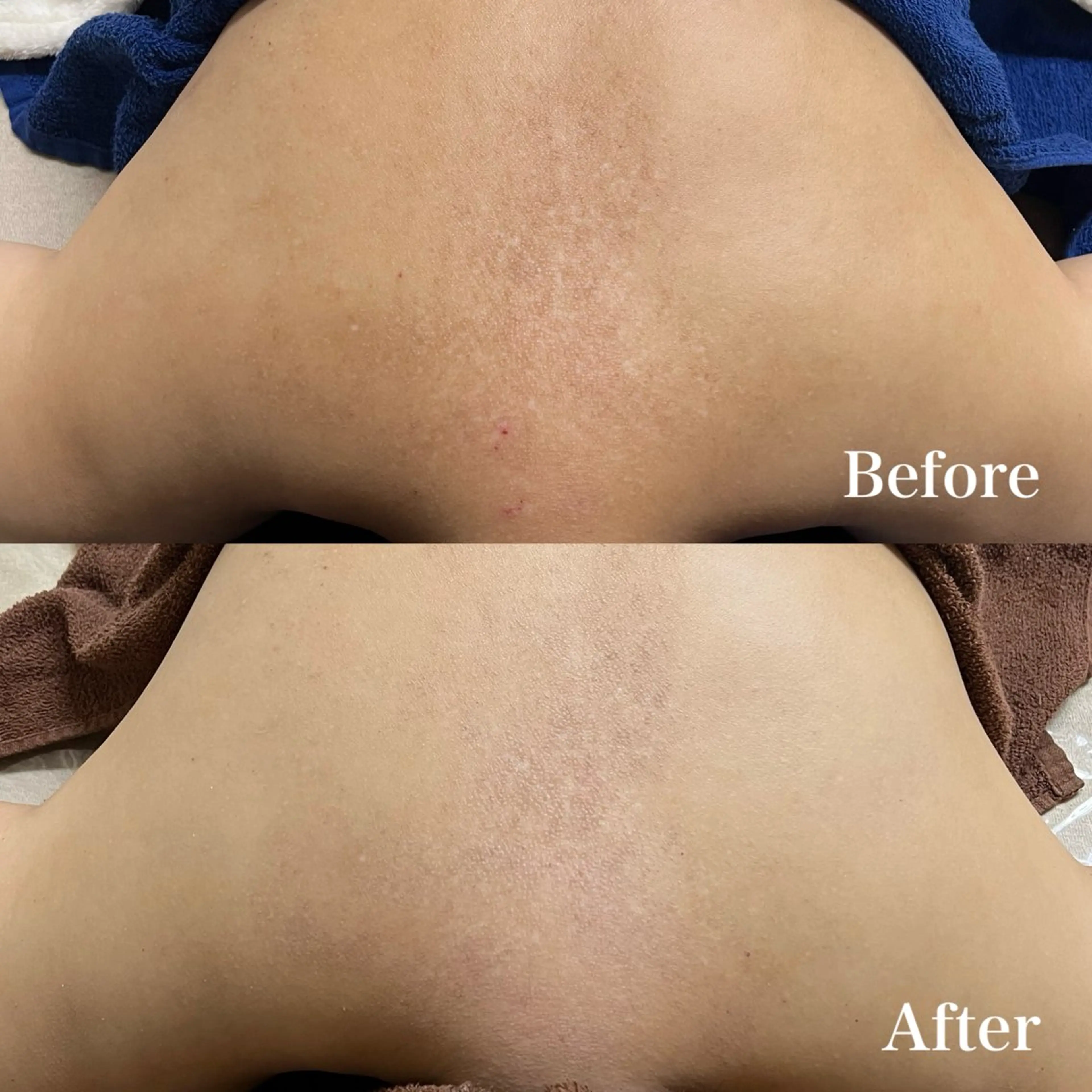 エステ 𝐌𝐚𝐜𝐡𝐞 𝐛𝐲 𝐌𝐚𝐲𝐮所属・ハーブピーリング🌿 𝑴𝒂𝒚𝒖のエステ・リラクイメージ