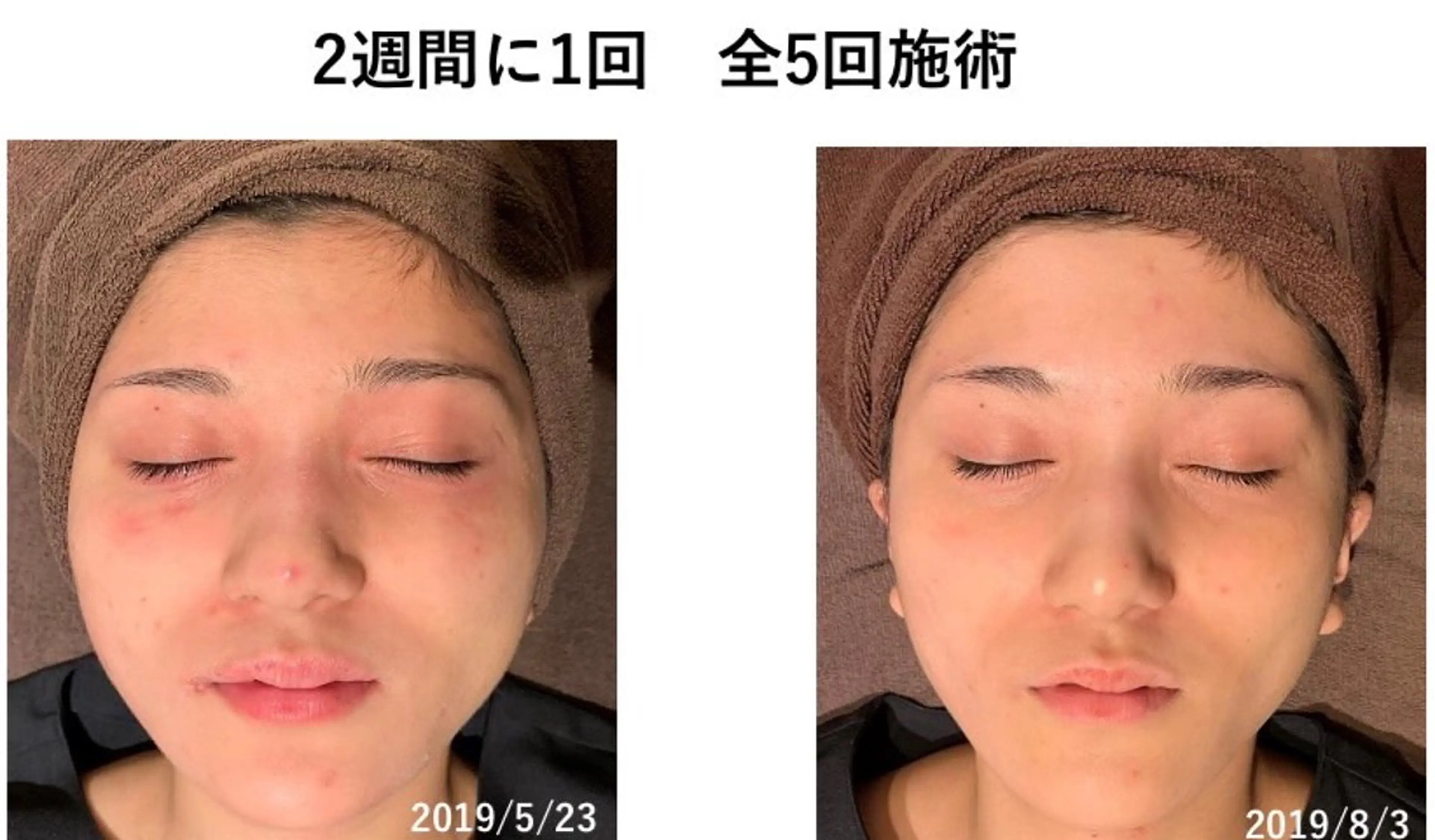 DTなし👋🏻‪新世代ピーリング"バイオピール®"どんな肌質の方でも施術可能💆🏻‍♀️施術直後からお肌ツルピカ✨の写真