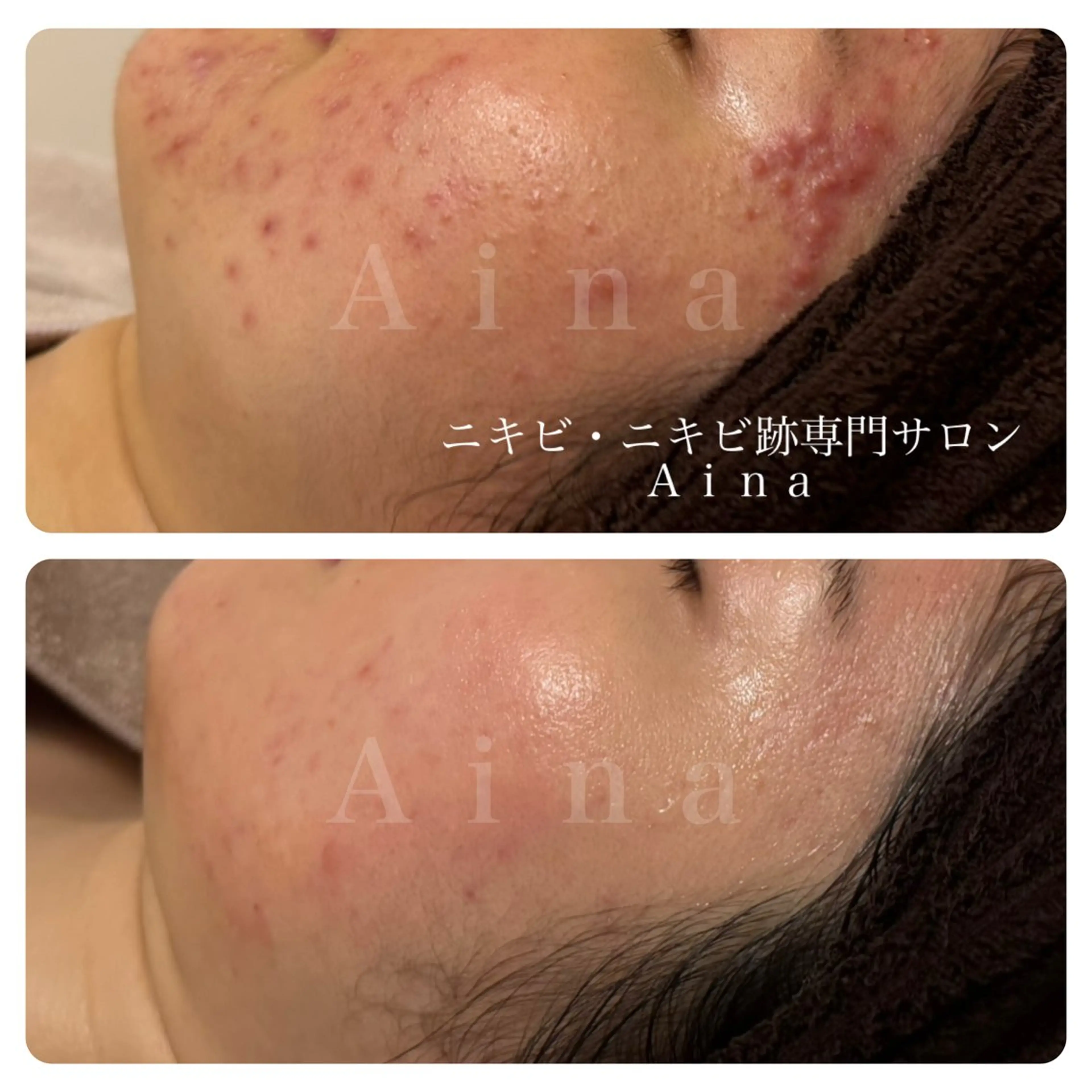 エステ リラク ニキビ跡専門サロン Ainaのエステ・リラクイメージ