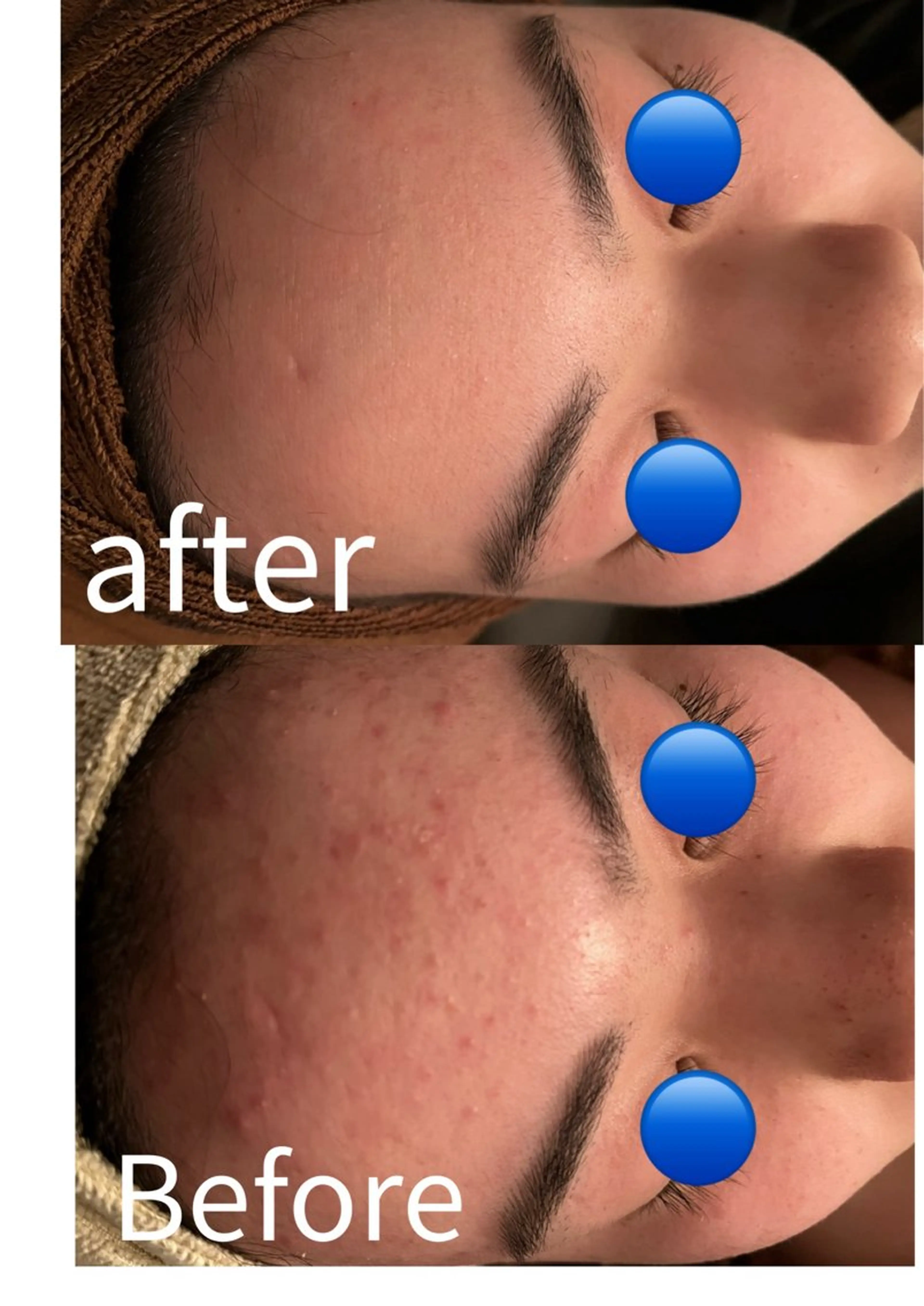 ニキビ、お任せコースの写真