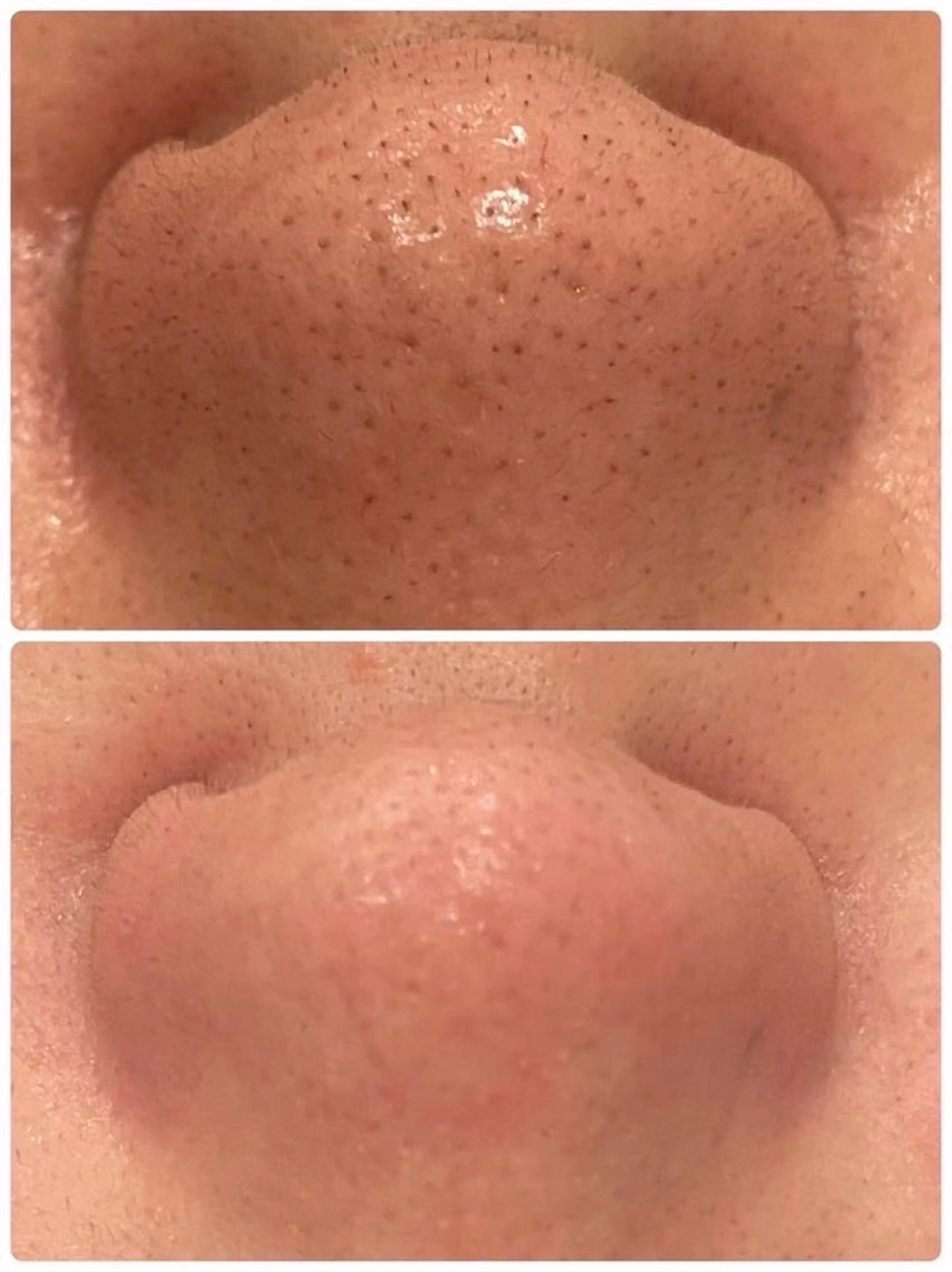 【4月末日まで】【毛穴開き/黒ずみ/いちご鼻】アクアピール+毛穴洗浄×高保湿ポレーション導入の写真