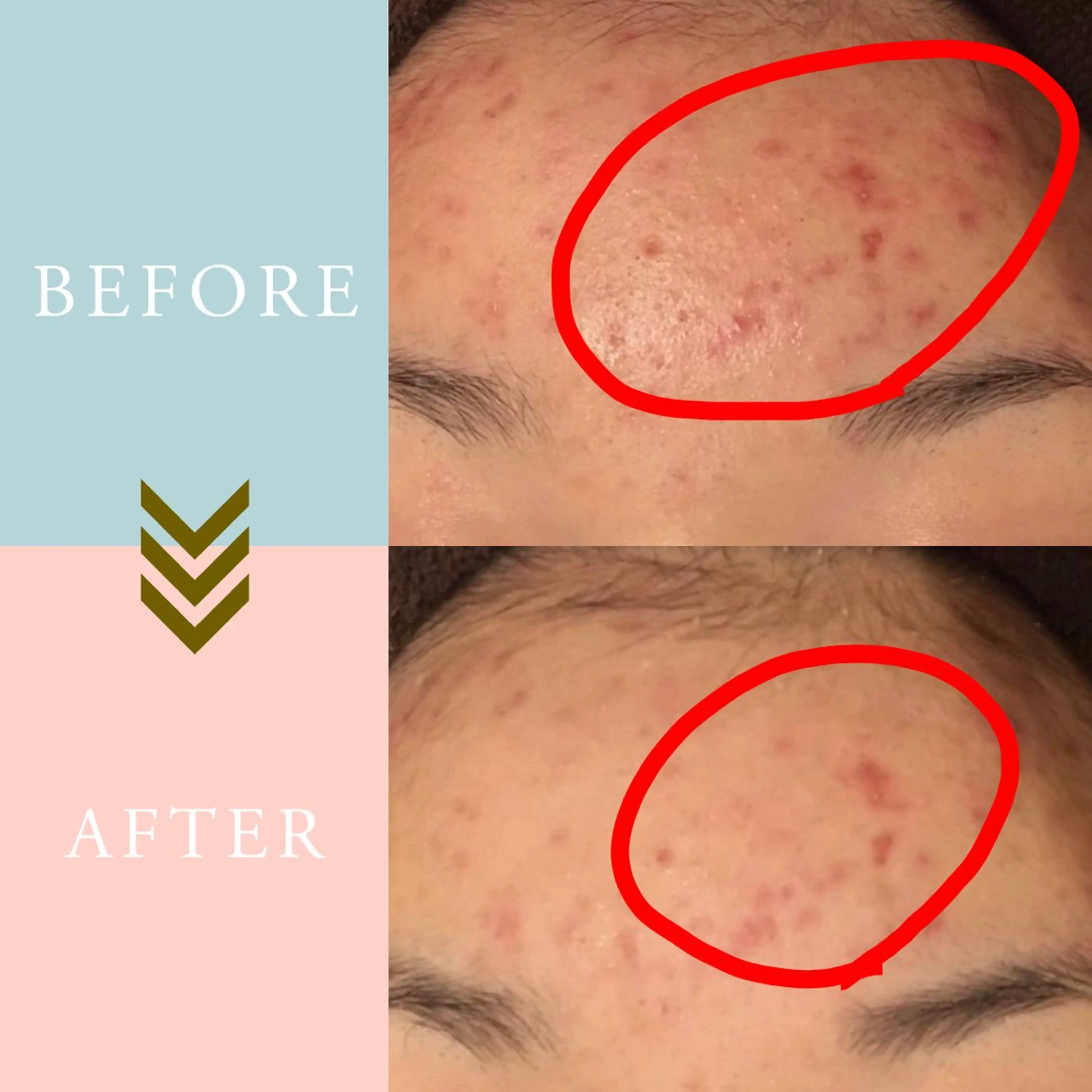 繰り返すニキビ・毛穴 ✨つくば肌質改善専門のエステ・リラクイメージ