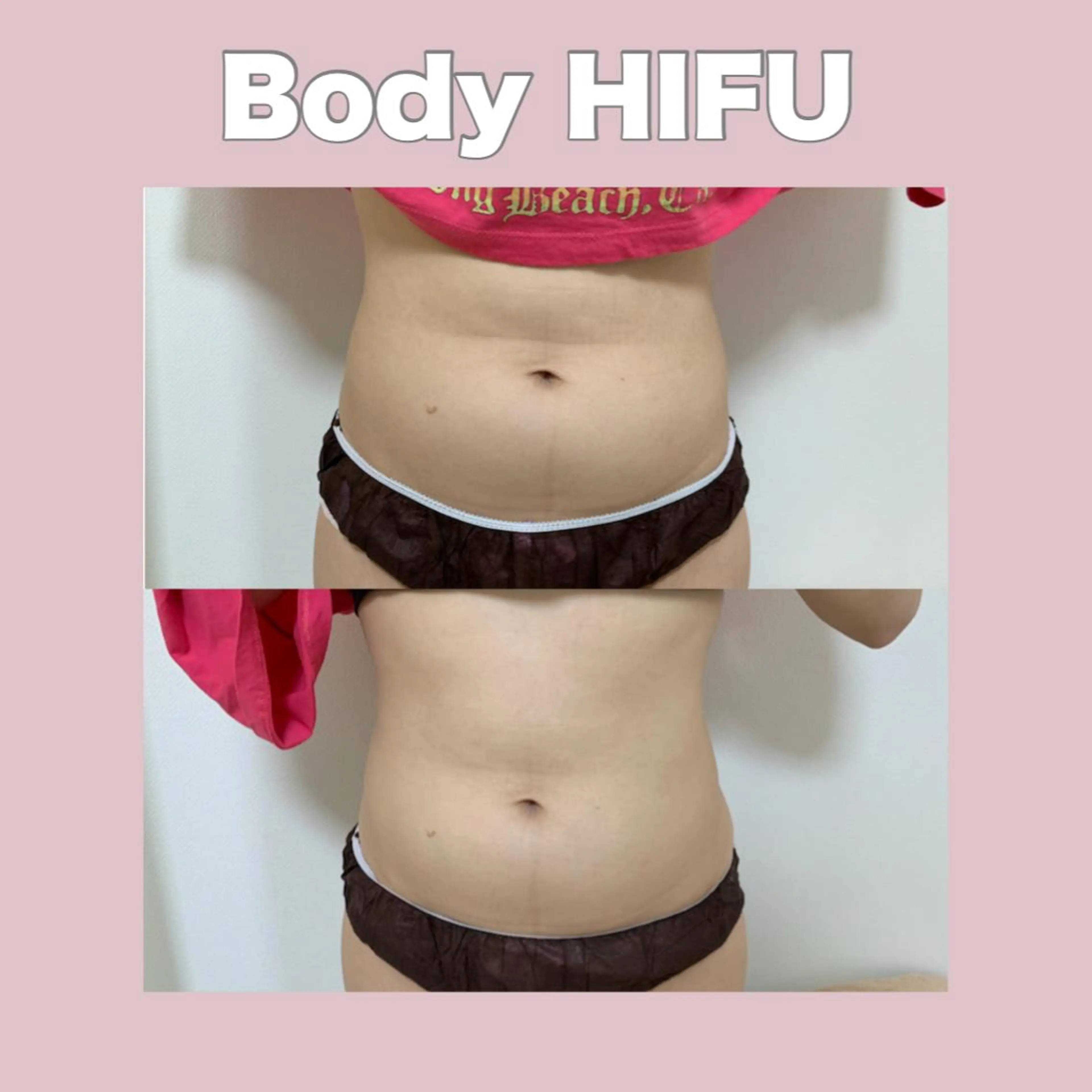 痩身マシンボディ 5000shotの写真