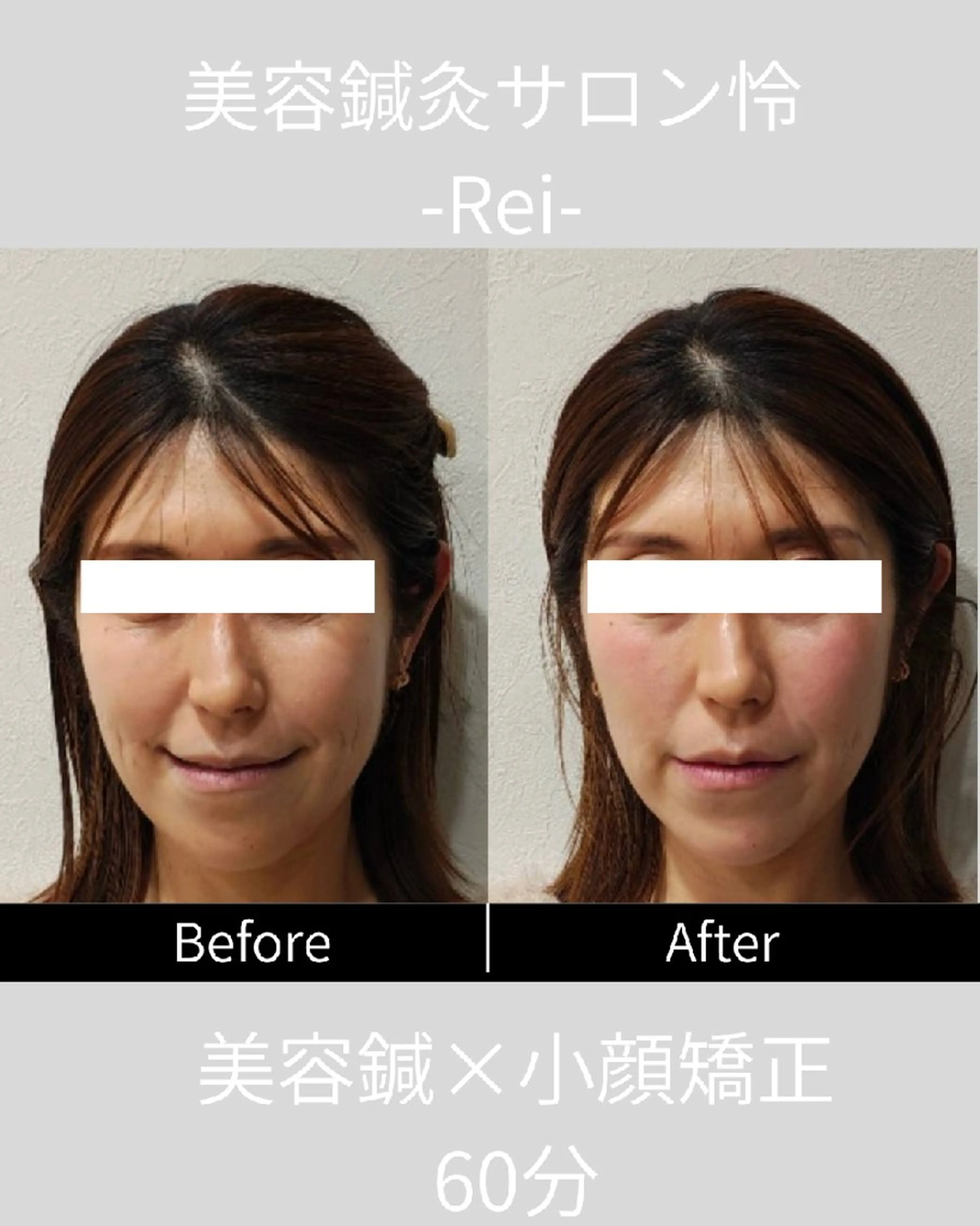 【OPEN記念✨️今月限定先着10名！人気No.1】スタンダード美容鍼コース＋選べる1種手技＋韓国式LED美顔器　60分の写真