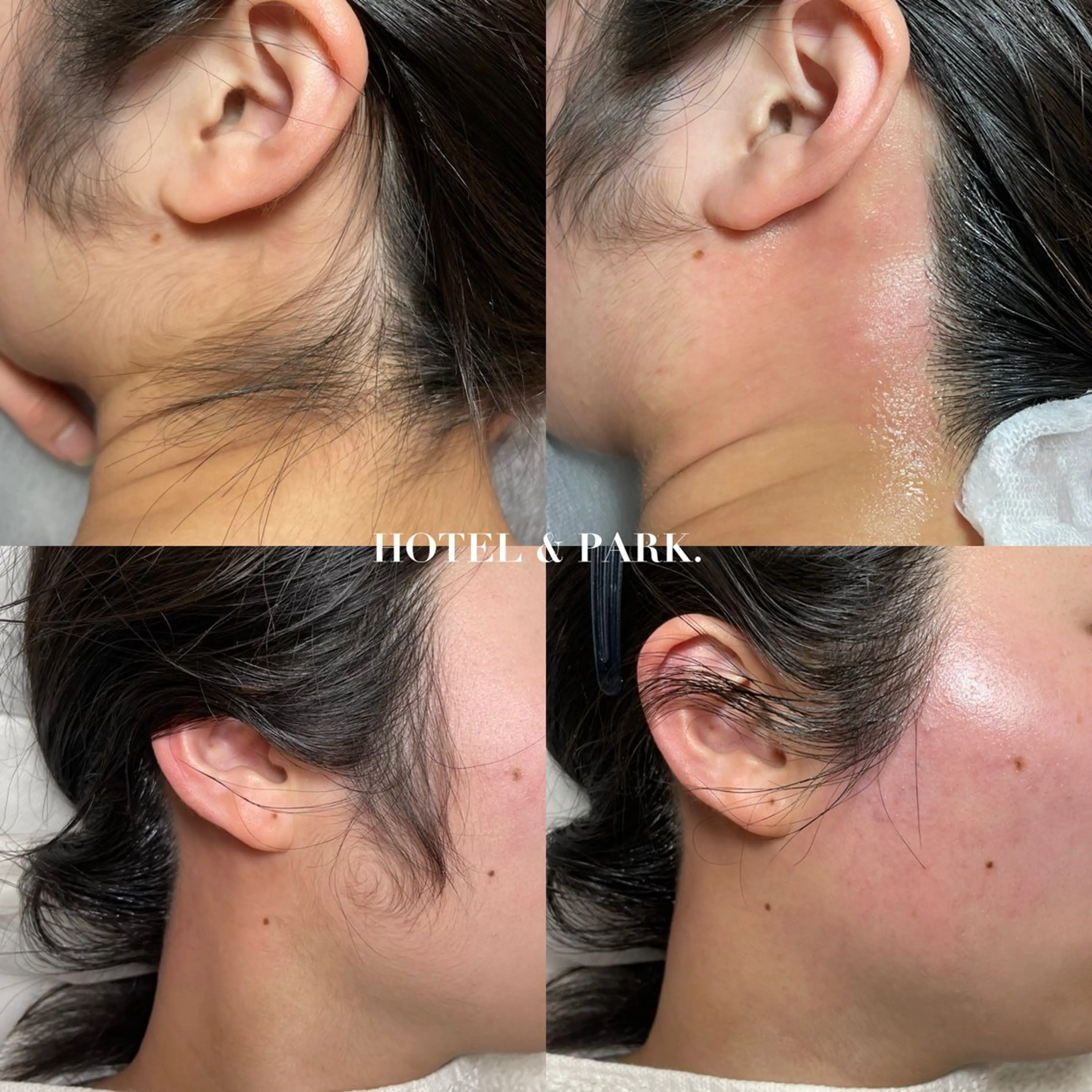 HOTEL&PARK . ワックス脱毛のエステ・リラクイメージ