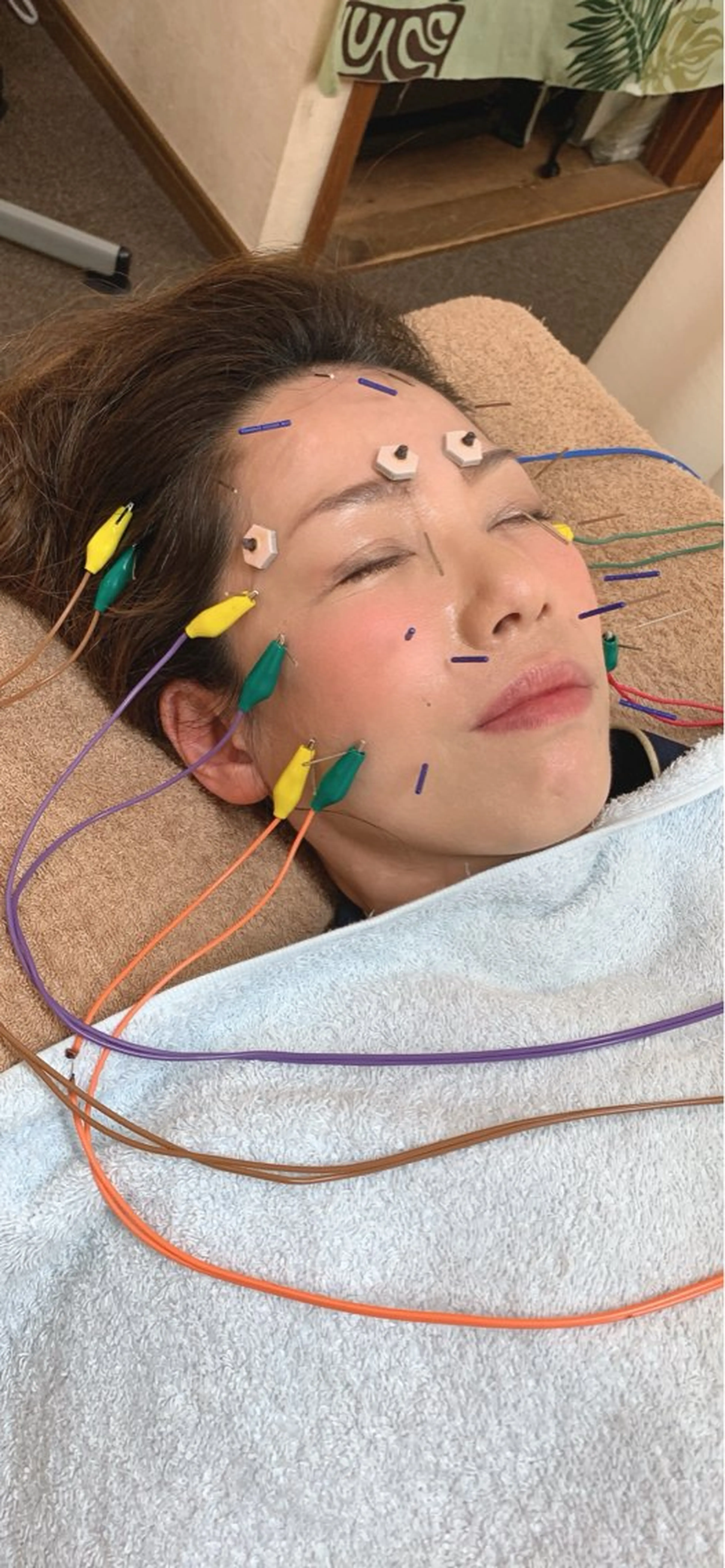 リフトアップ美容鍼　肩首マッサージ　（頭皮からの引き上げ）28本の写真