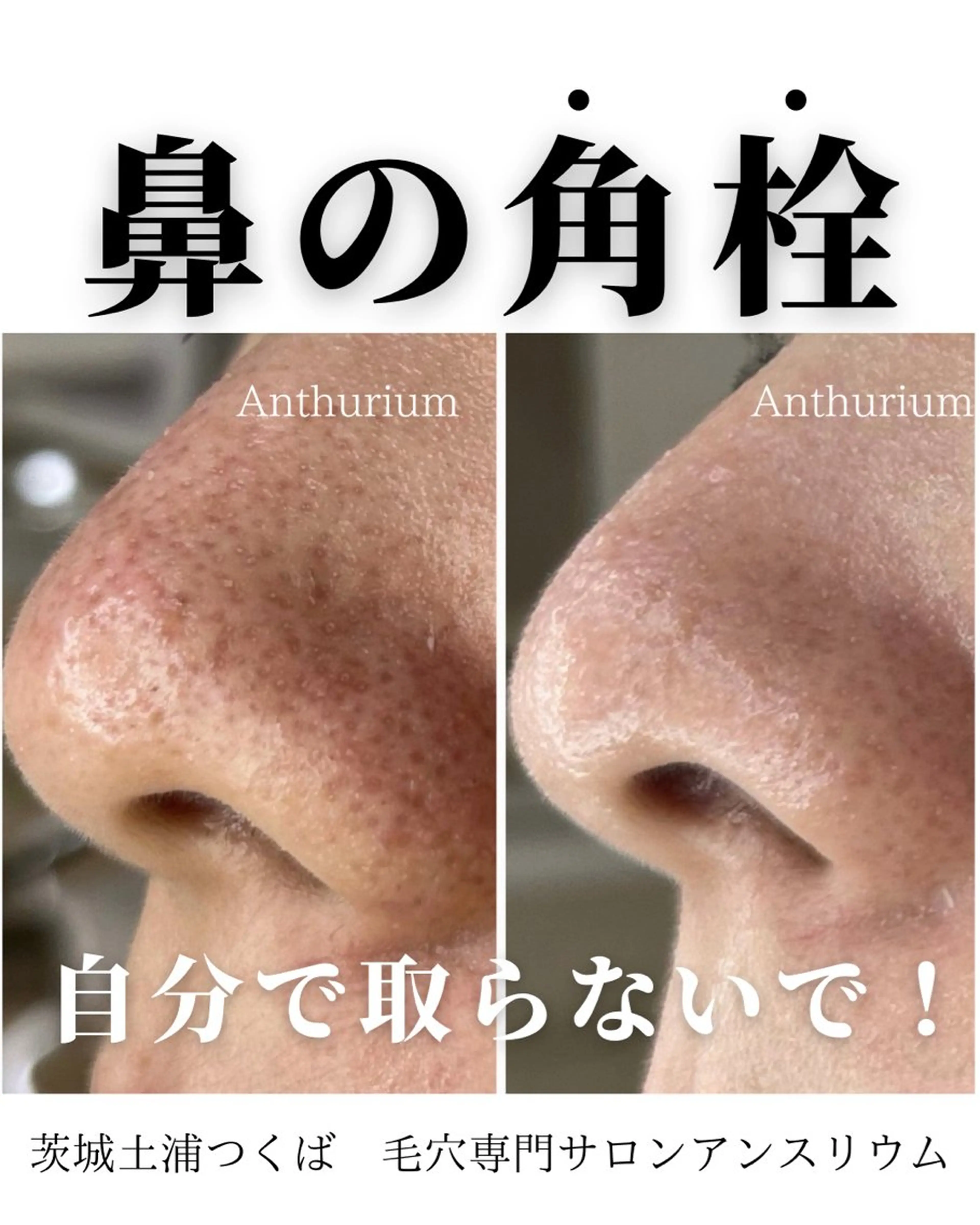 毛穴ケア専門サロンアンスリウム所属・茨城土浦 つくば毛穴 ケア専門サロンのエステ・リラクイメージ