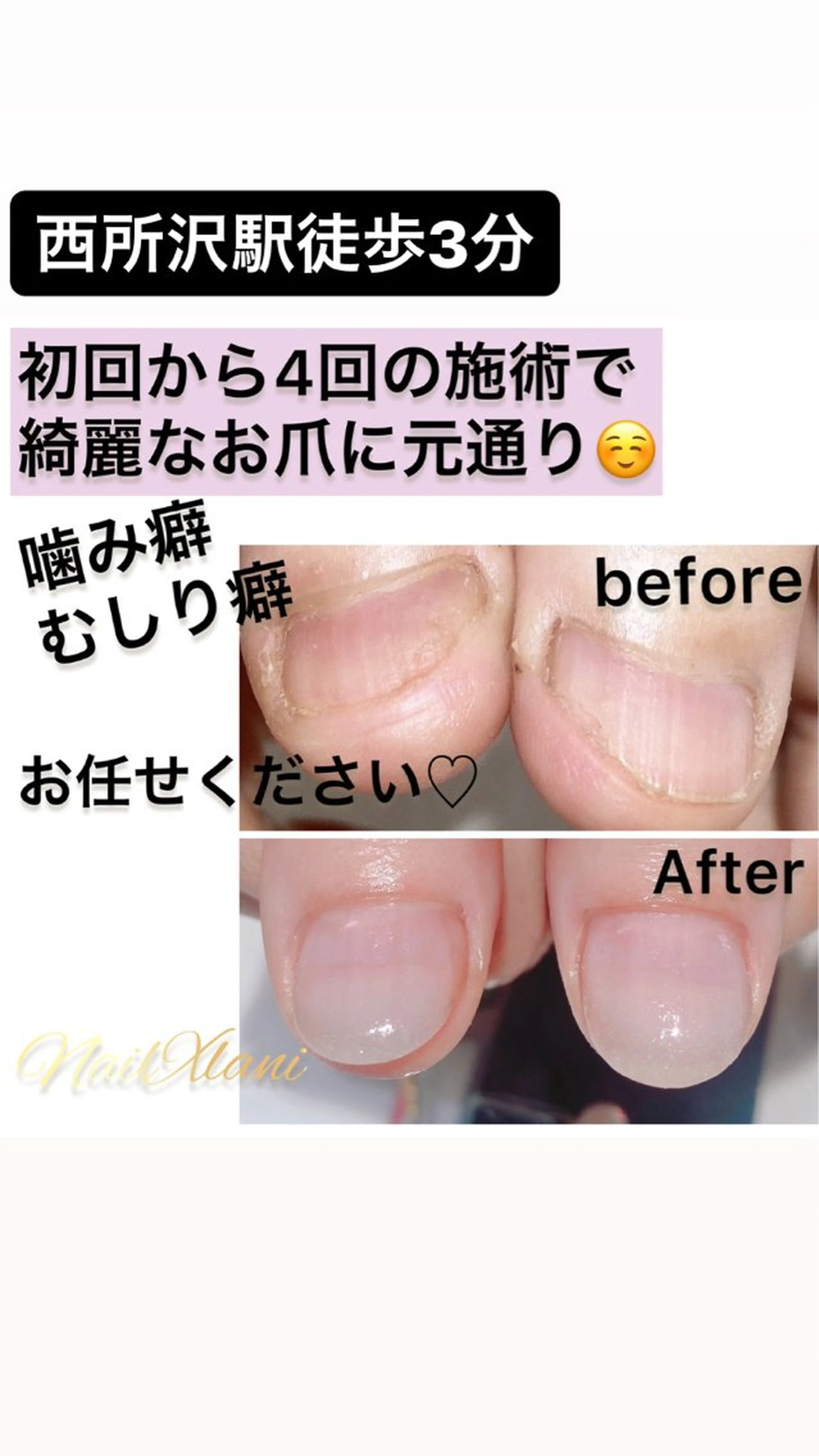 ネイル ハンドネイル Nail×Lani 深爪矯正対応◎のネイルデザイン
