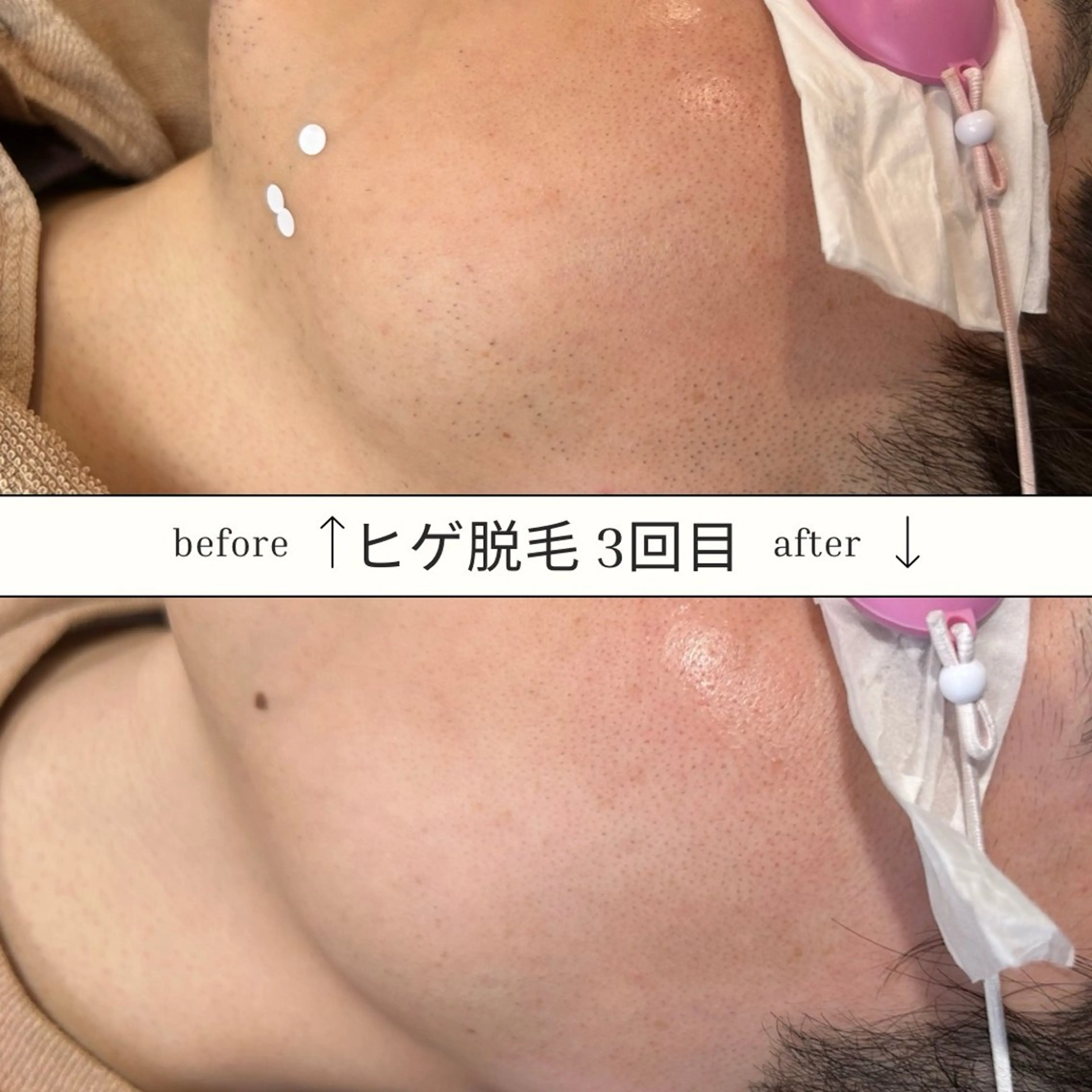 メンズ 脱毛 SKIN GYM メンズ専門脱毛サロンのエステ・リラクイメージ