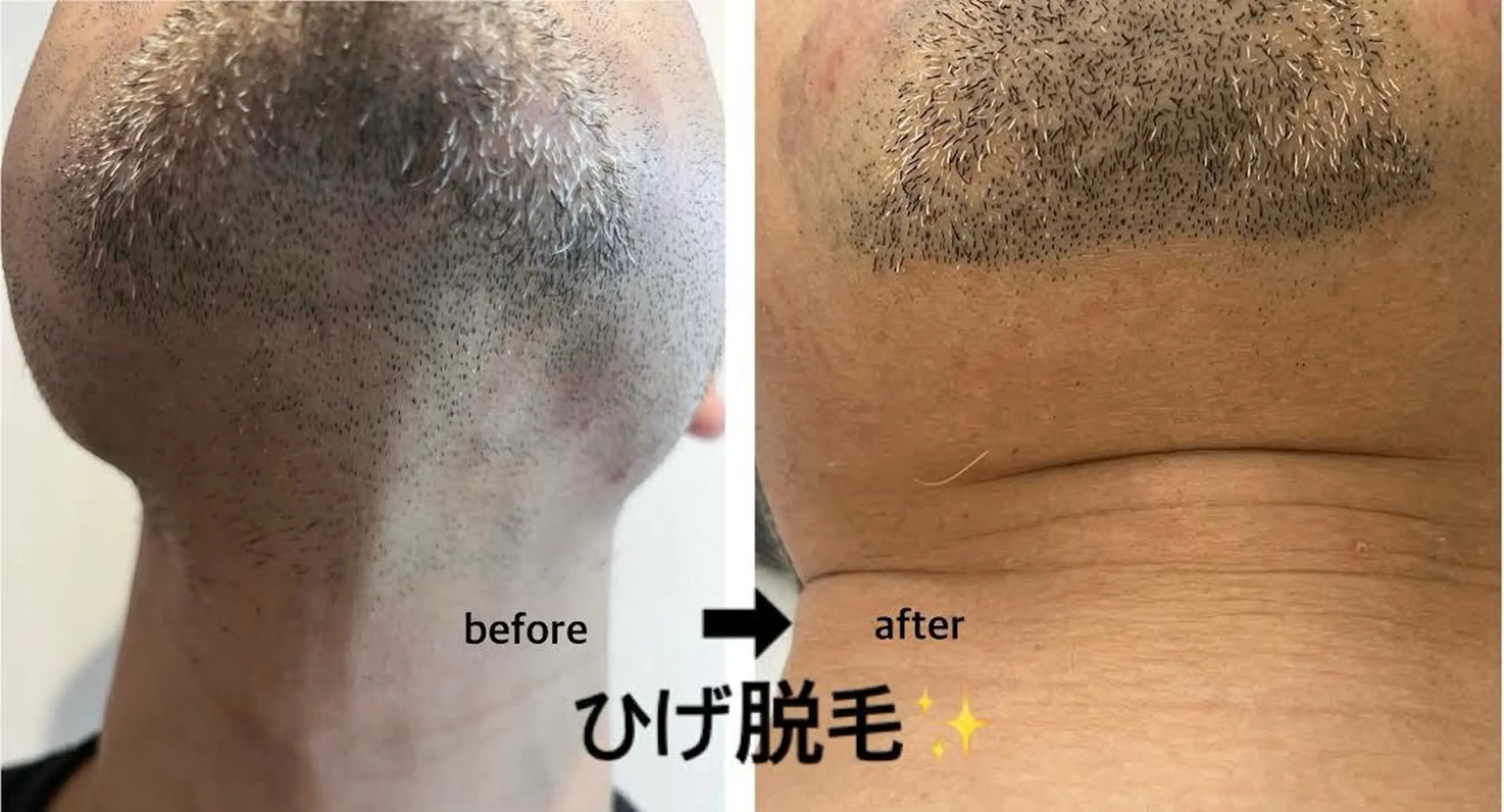 メンズ 脱毛 韓国肌管理×毛穴 改善専門🤍nanaのエステ・リラクイメージ