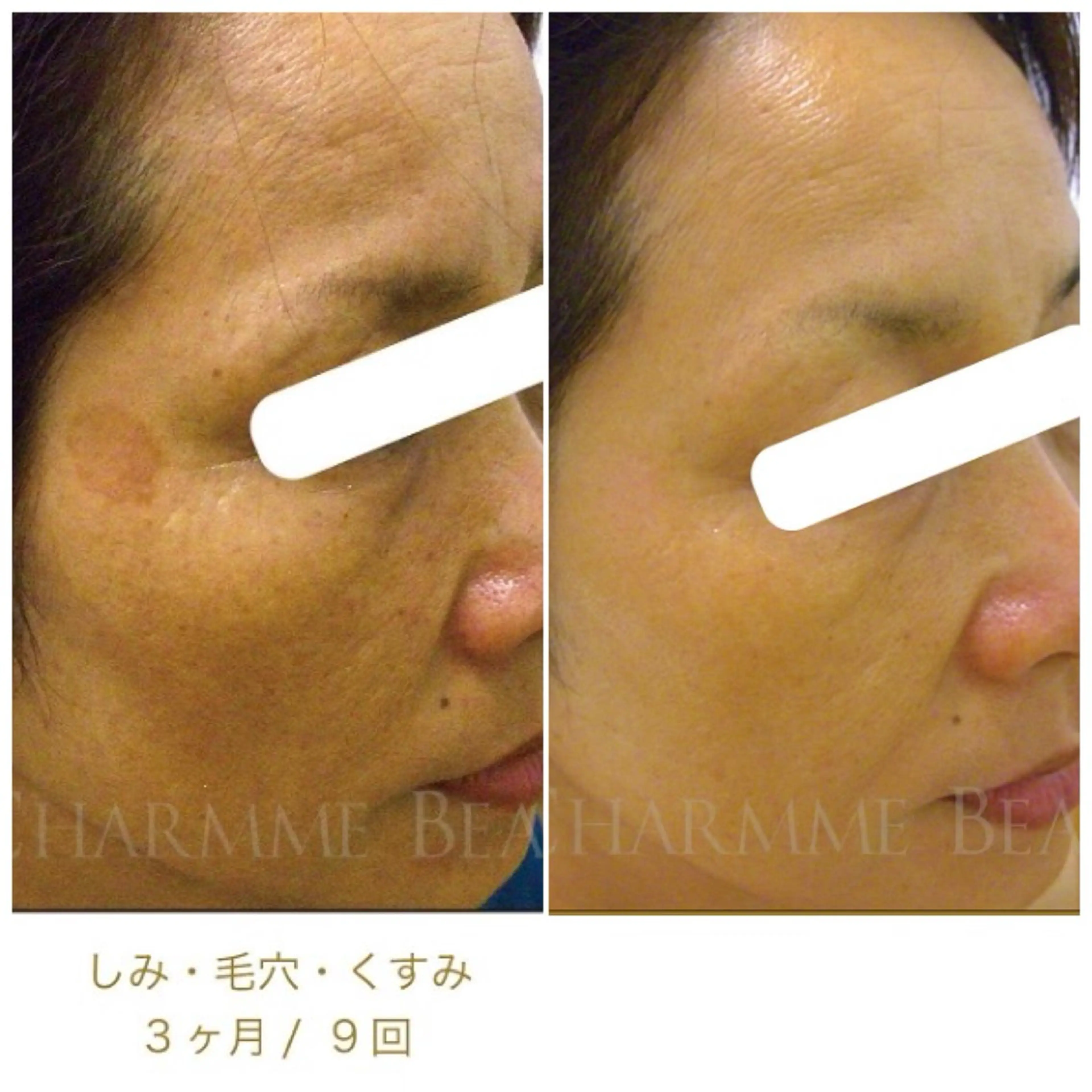 【シミ、シワ、たるみ、ニキビ、毛穴】あらゆる悩みを改善する肌質改善プログラム🌿最短3ヶ月〜お肌のパーソナルジムの写真