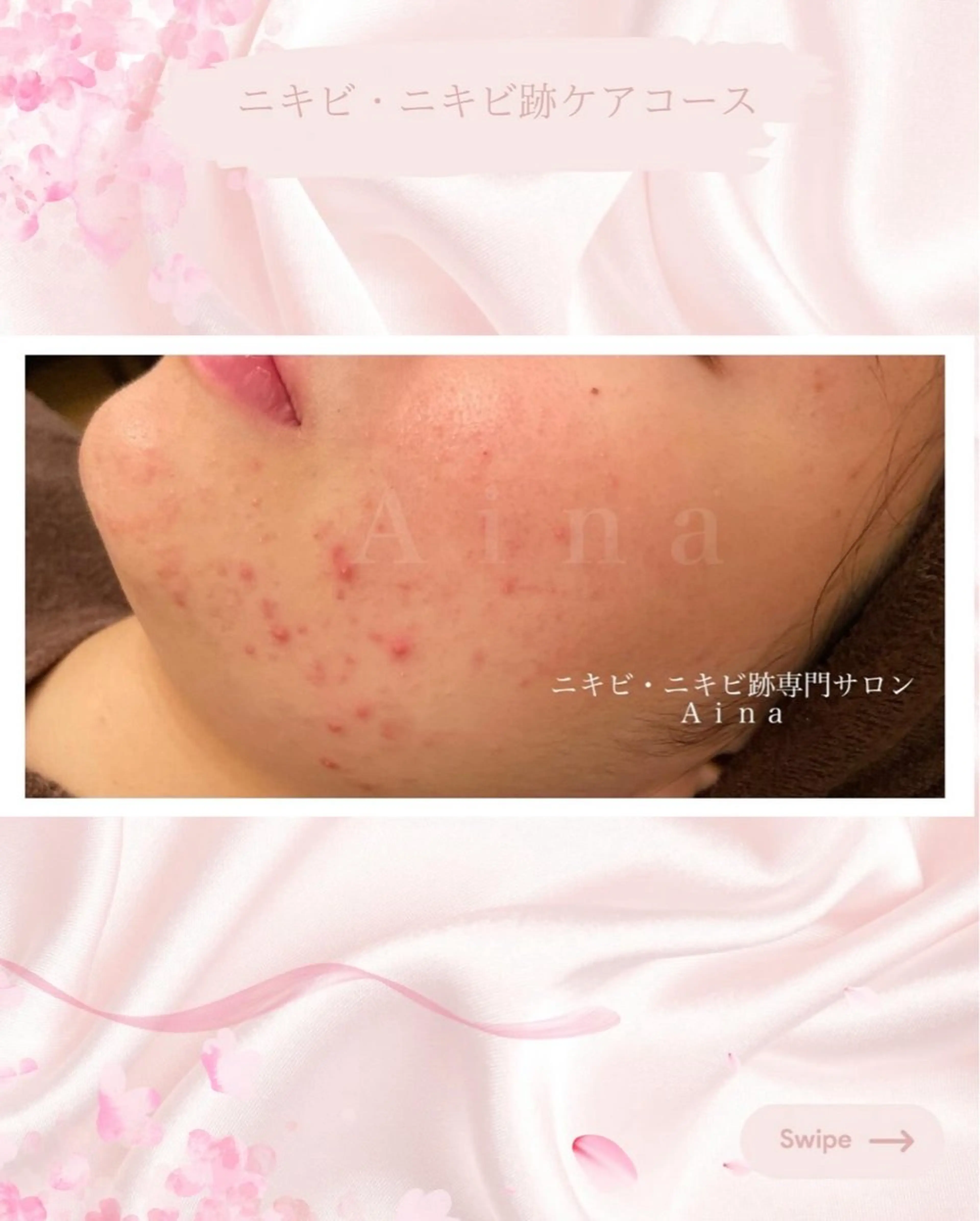 ニキビ跡専門サロン Ainaのエステ・リラクイメージ