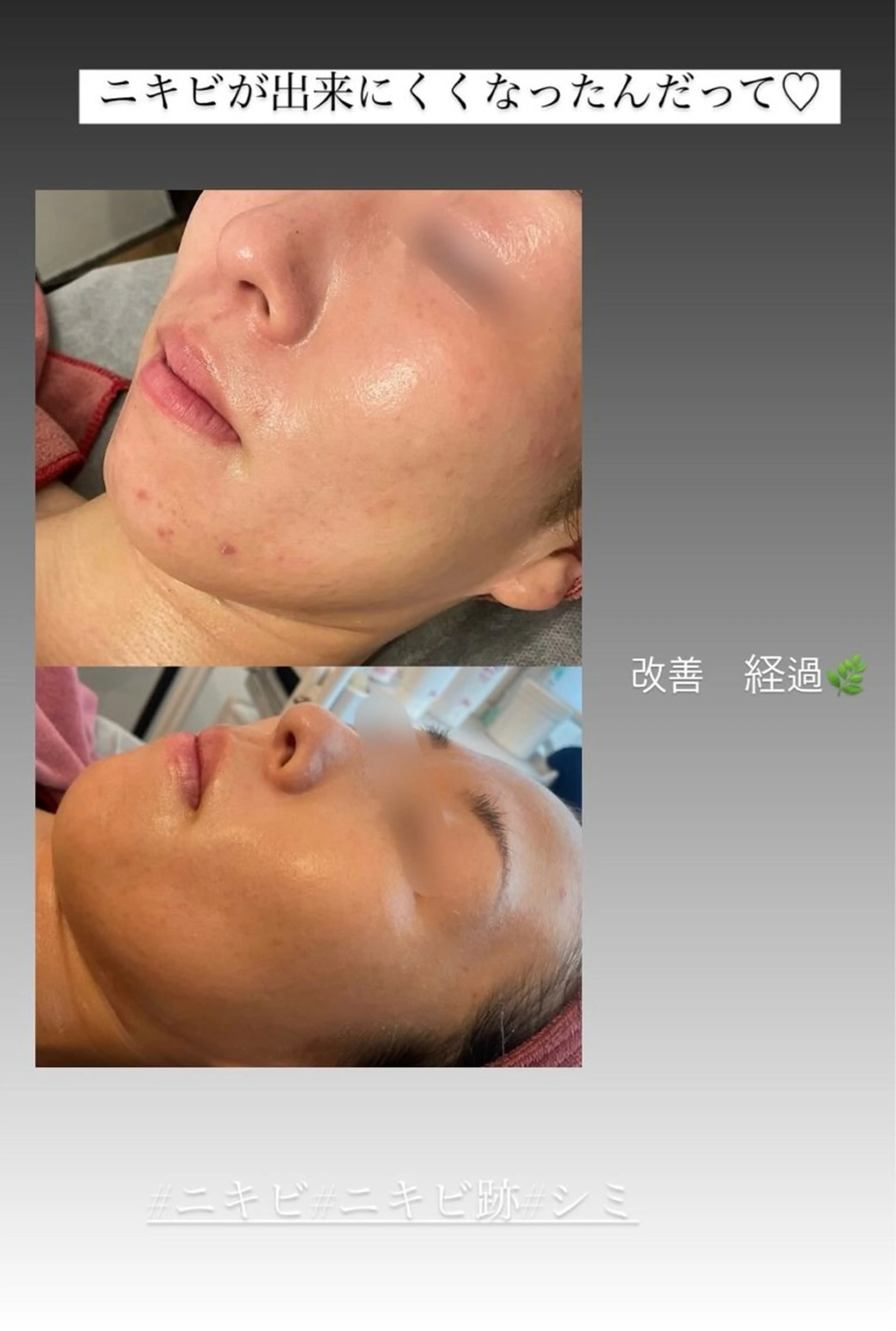 半田市エステサロン　シェソワ所属・ニキビ/疲労回復ケア シェソワのエステ・リラクイメージ