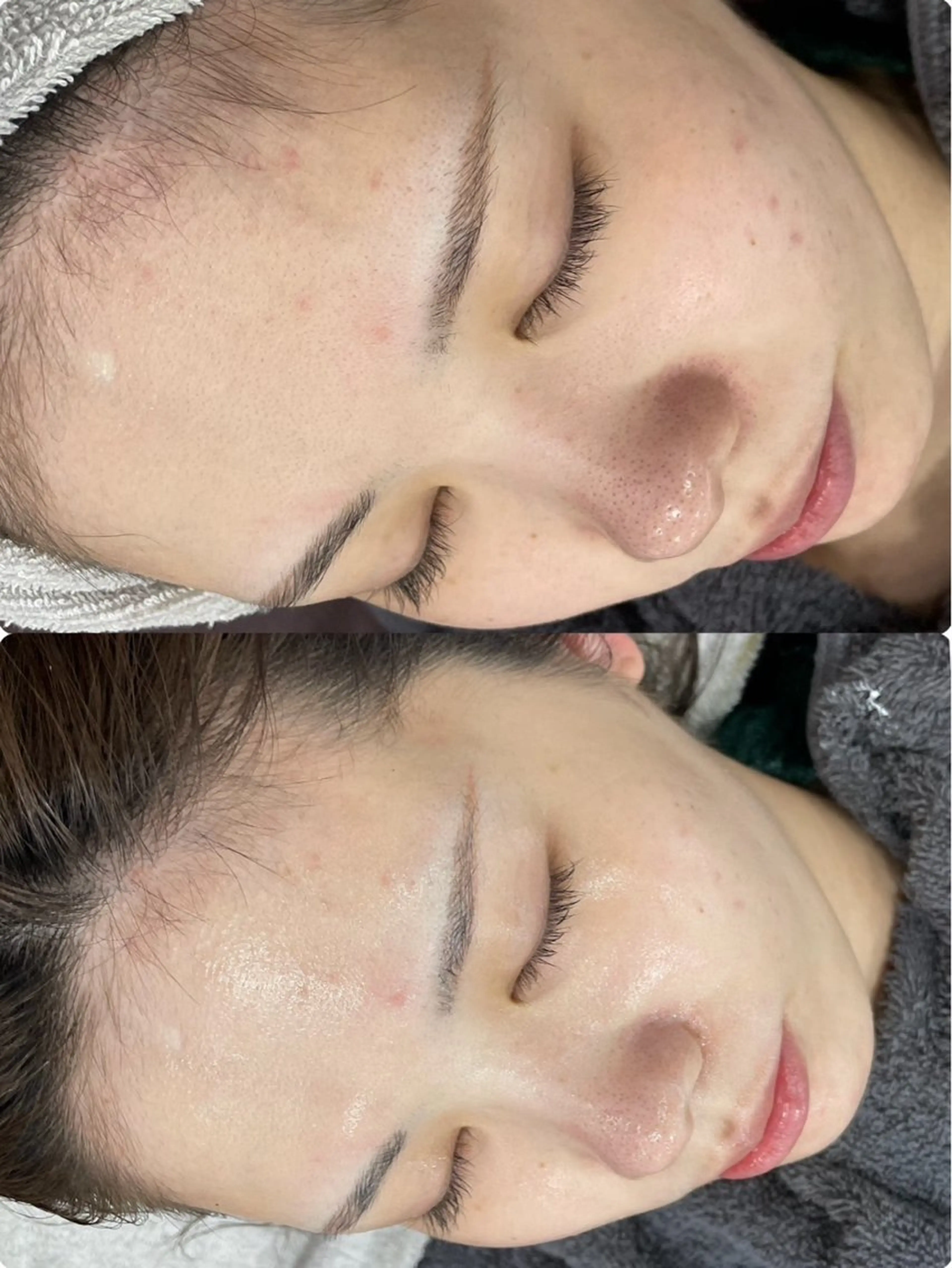 ニキビ／毛穴ケア ハーブピーリングのエステ・リラクイメージ