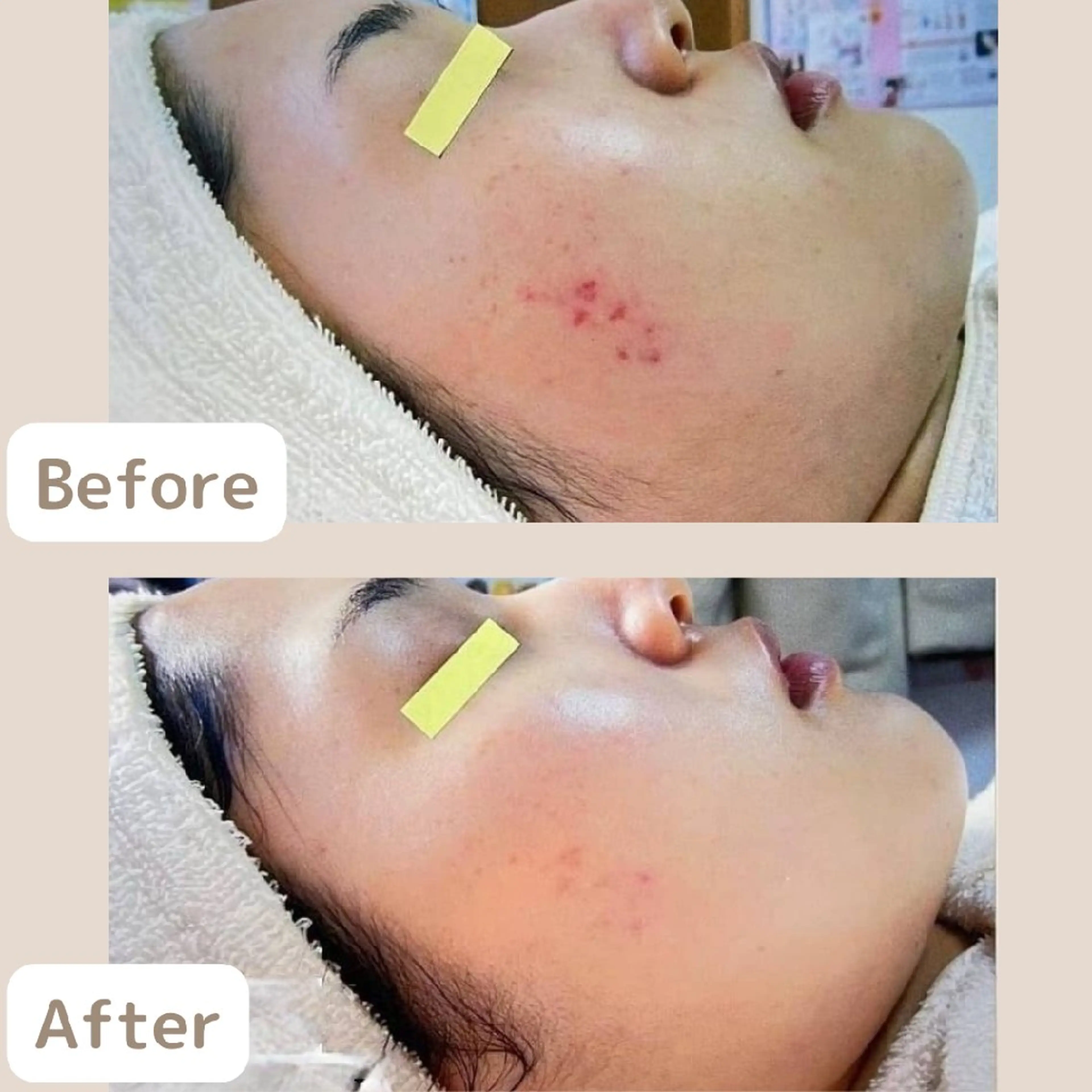 〈ニキビケアサロン〉 レゾン京橋店/ 浅川のエステ・リラクイメージ