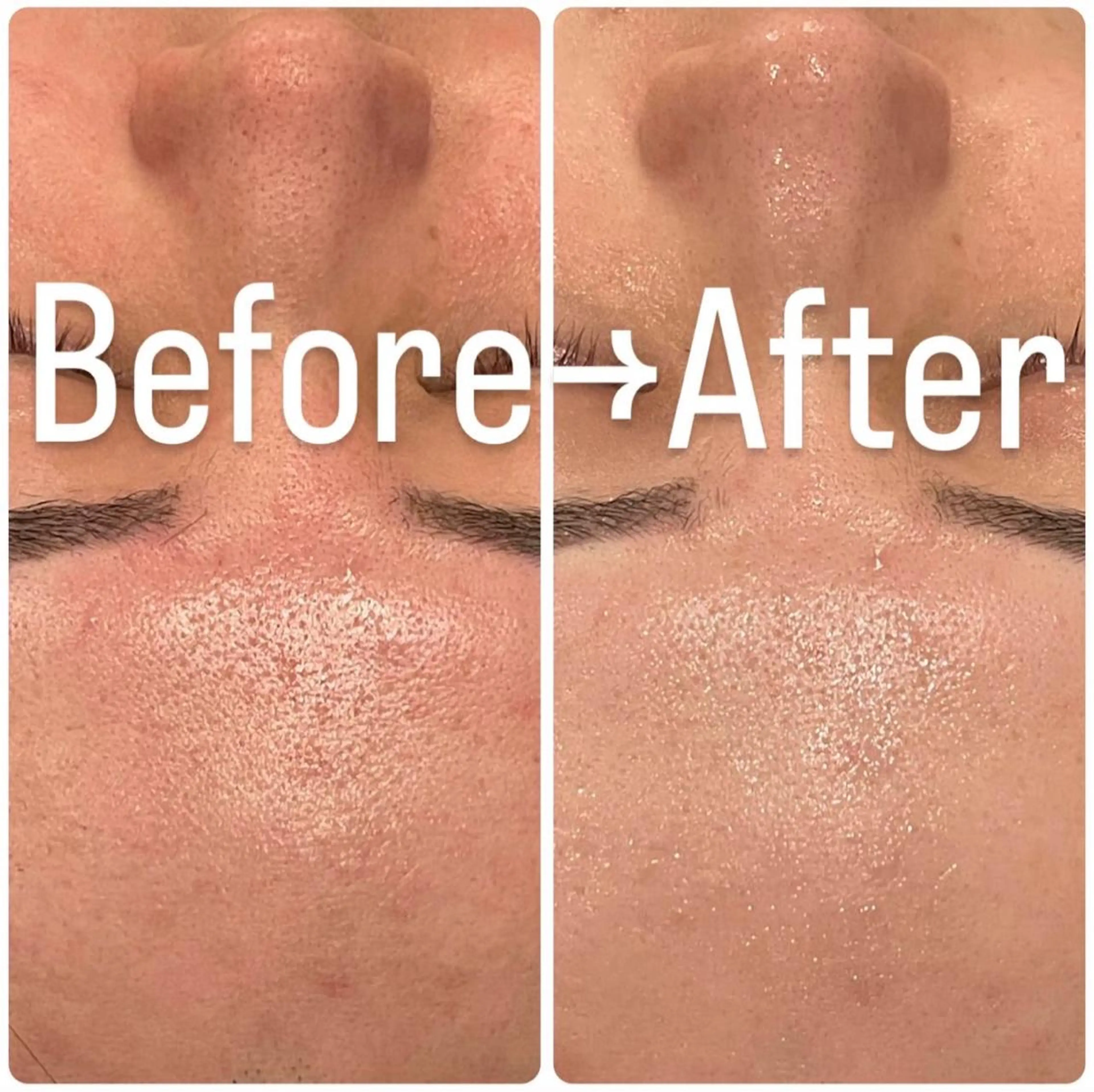 ✨肌質激変✨REVIハーブピーリングで陶器肌へ🌿お肌の悩みを根本から解決します♪[心斎橋/メンズ］の写真