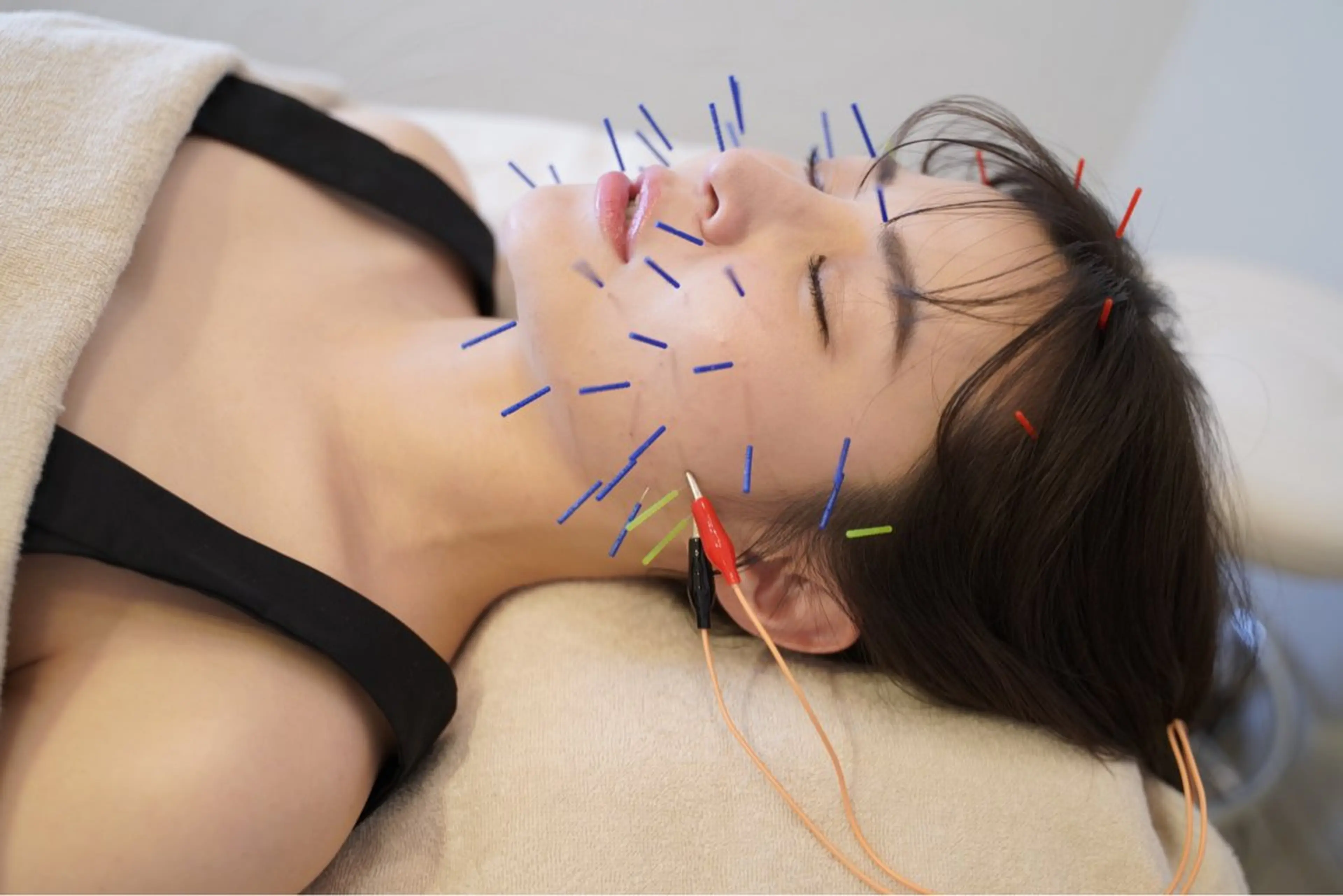 オーダーメイド小顔美容鍼🧸✨爆縮小顔🔥むくみ/エラ張り/お顔の余白が気になる方におすすめ👼🏻✨の写真