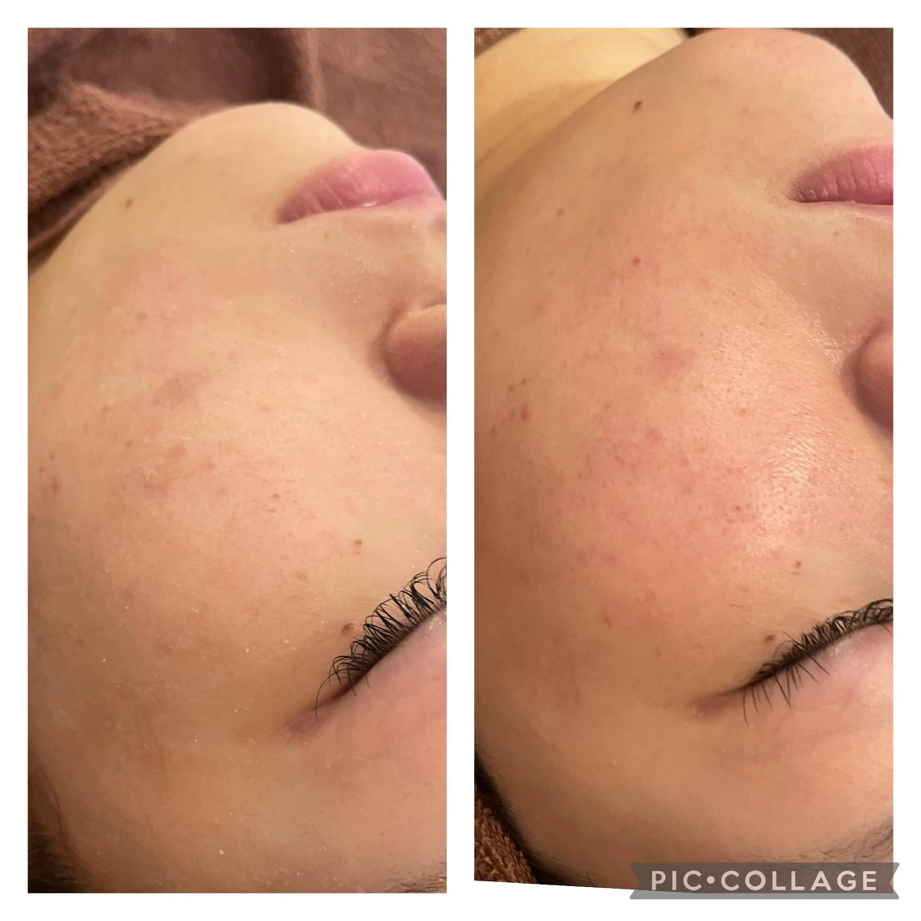 セミロング カラー パーマ ヘアアレンジ メンズ キッズ ネイル マツエク・マツパ エステ リラク ニキビ特化型エステ 🍋最短で肌質改善のエステ・リラクイメージ