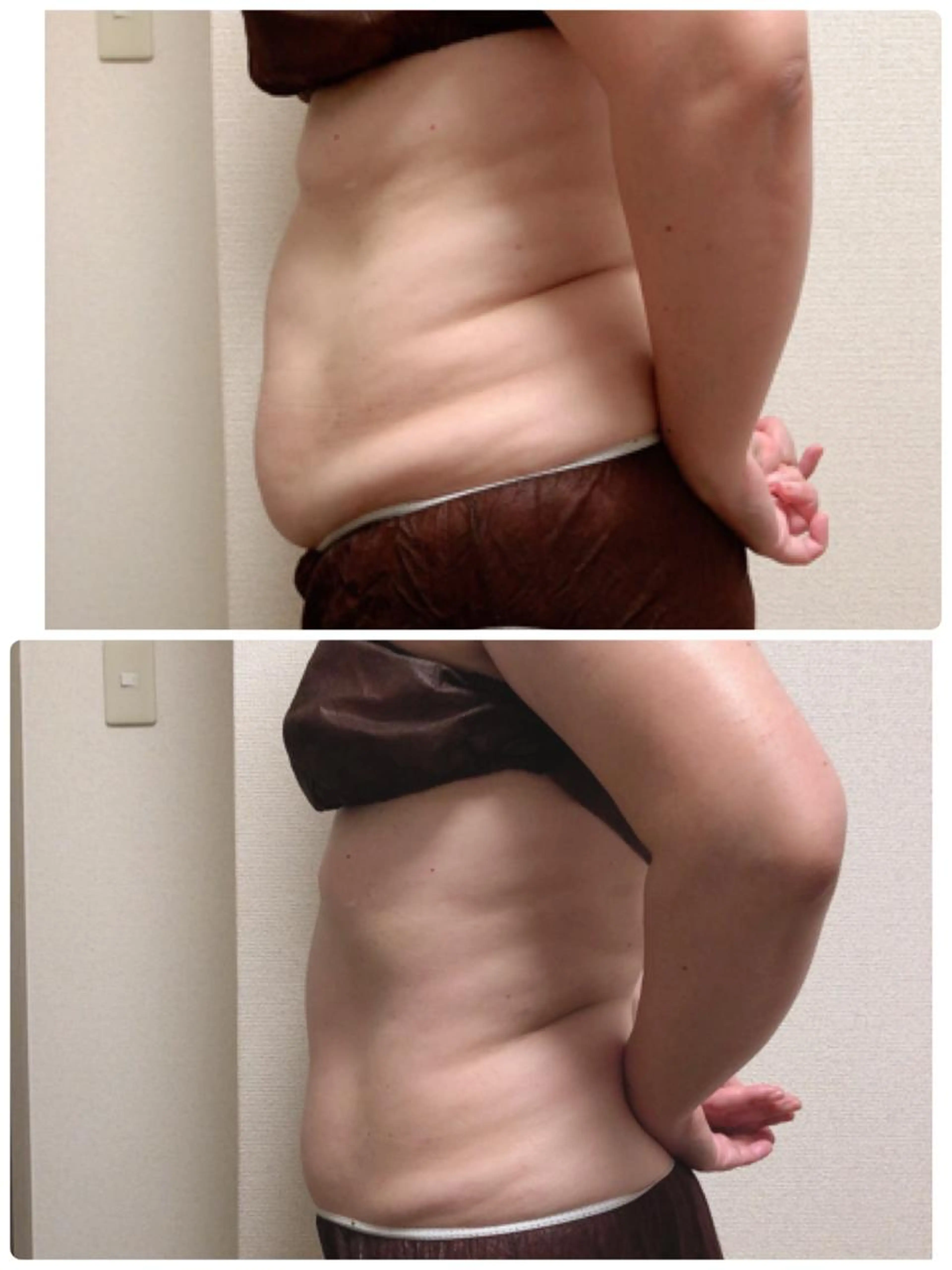 ぽっこりお腹集中コース（脂肪にアプローチする機器とハンドテクニックですっきりお腹を目指すコースです。）の写真