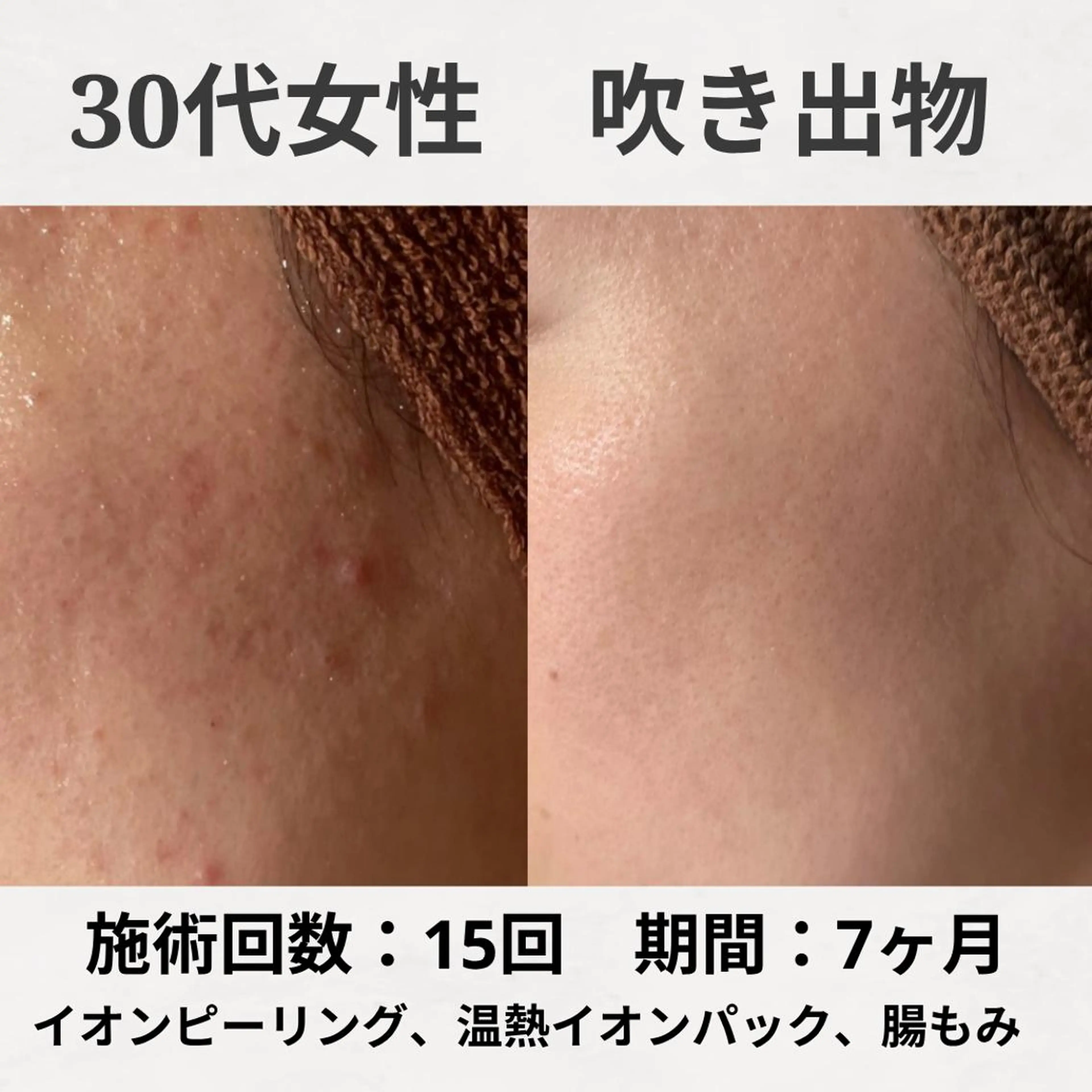 エステ リラク ニキビ跡改善専門🔥 医療にはできない改善のエステ・リラクイメージ