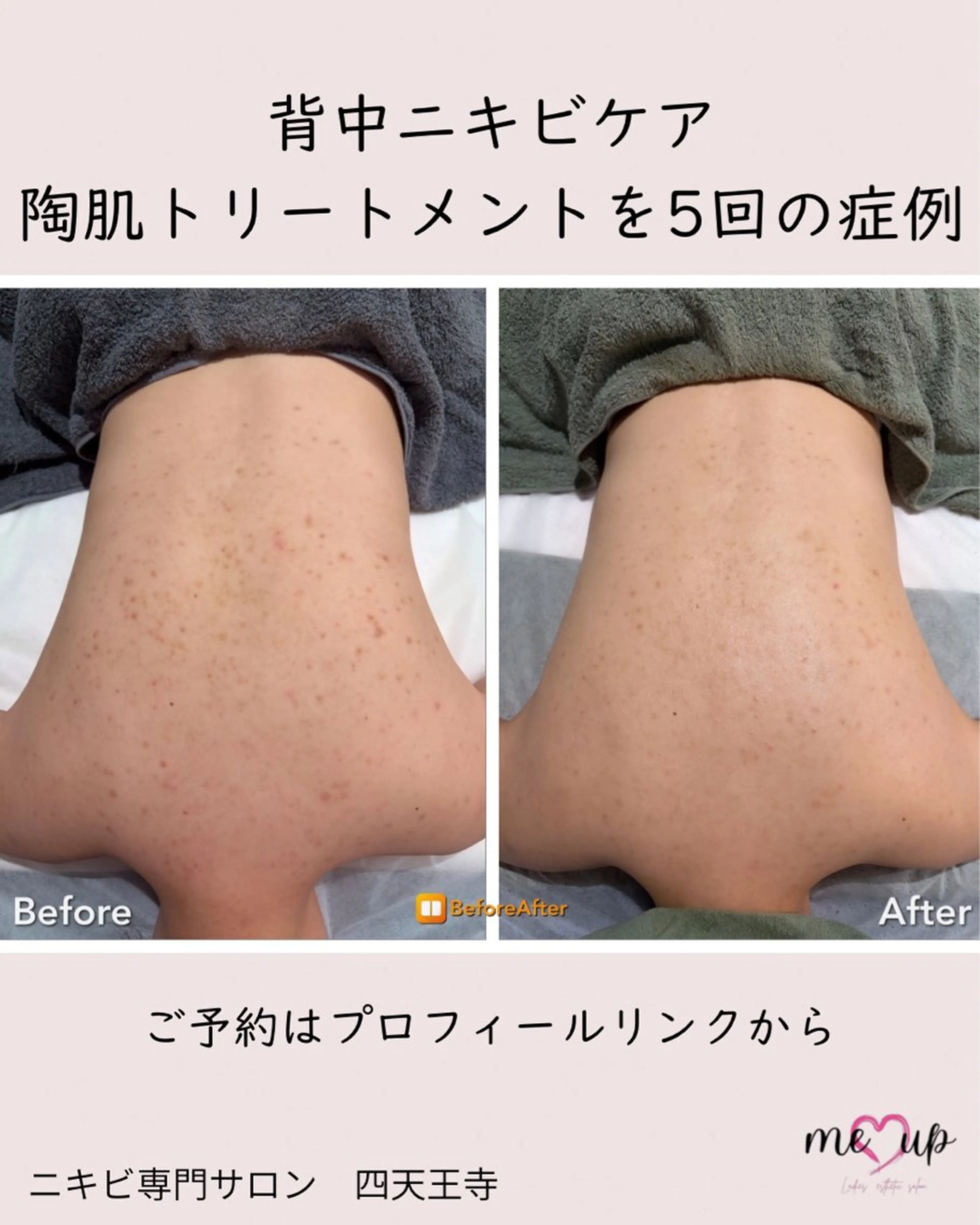 エステ Meupニキビ専門店 背中/ハーブ/肌管理のその他イメージ