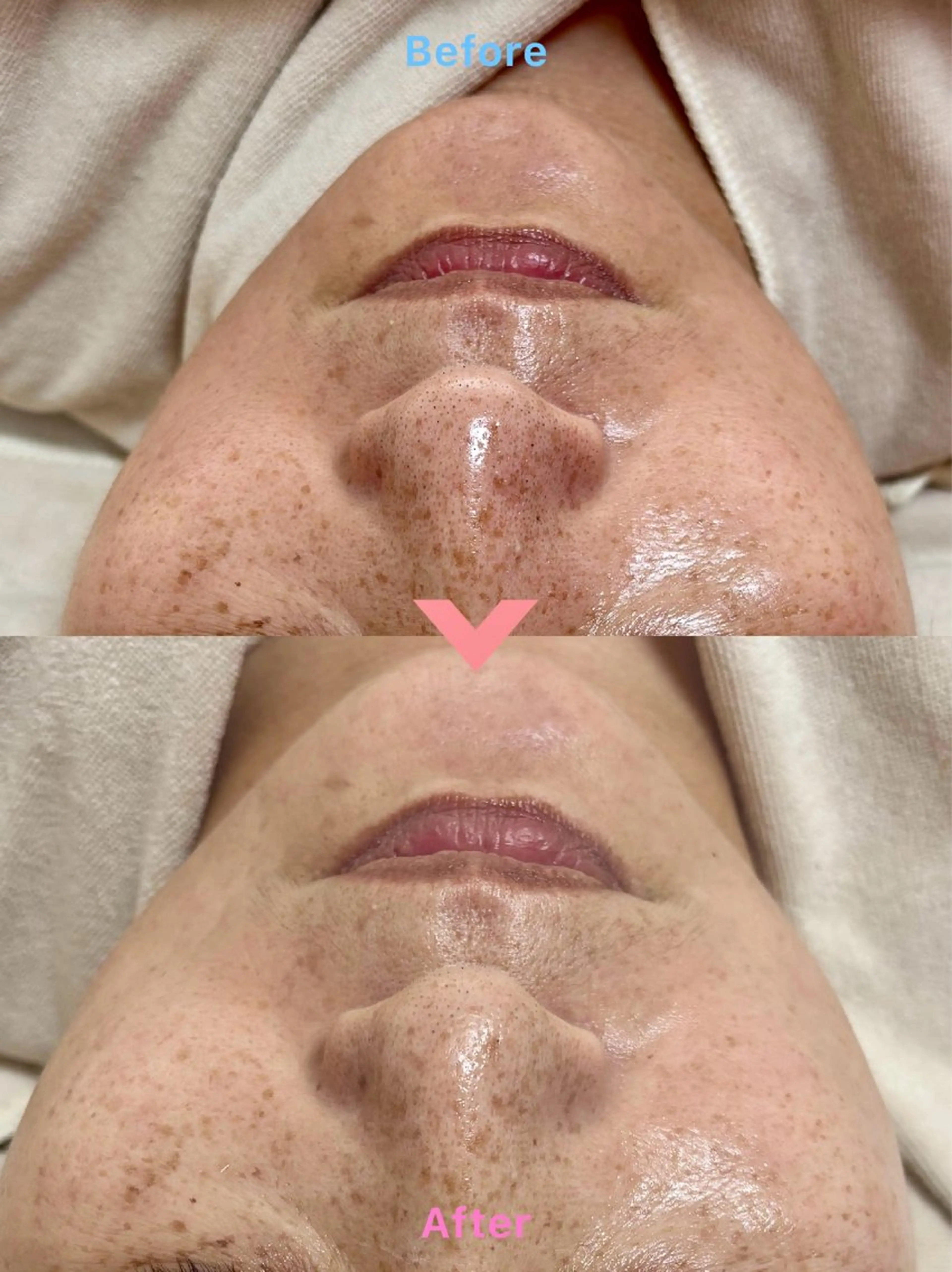 肌質改善Lino 毛穴・ニキビケア専門のエステ・リラクイメージ