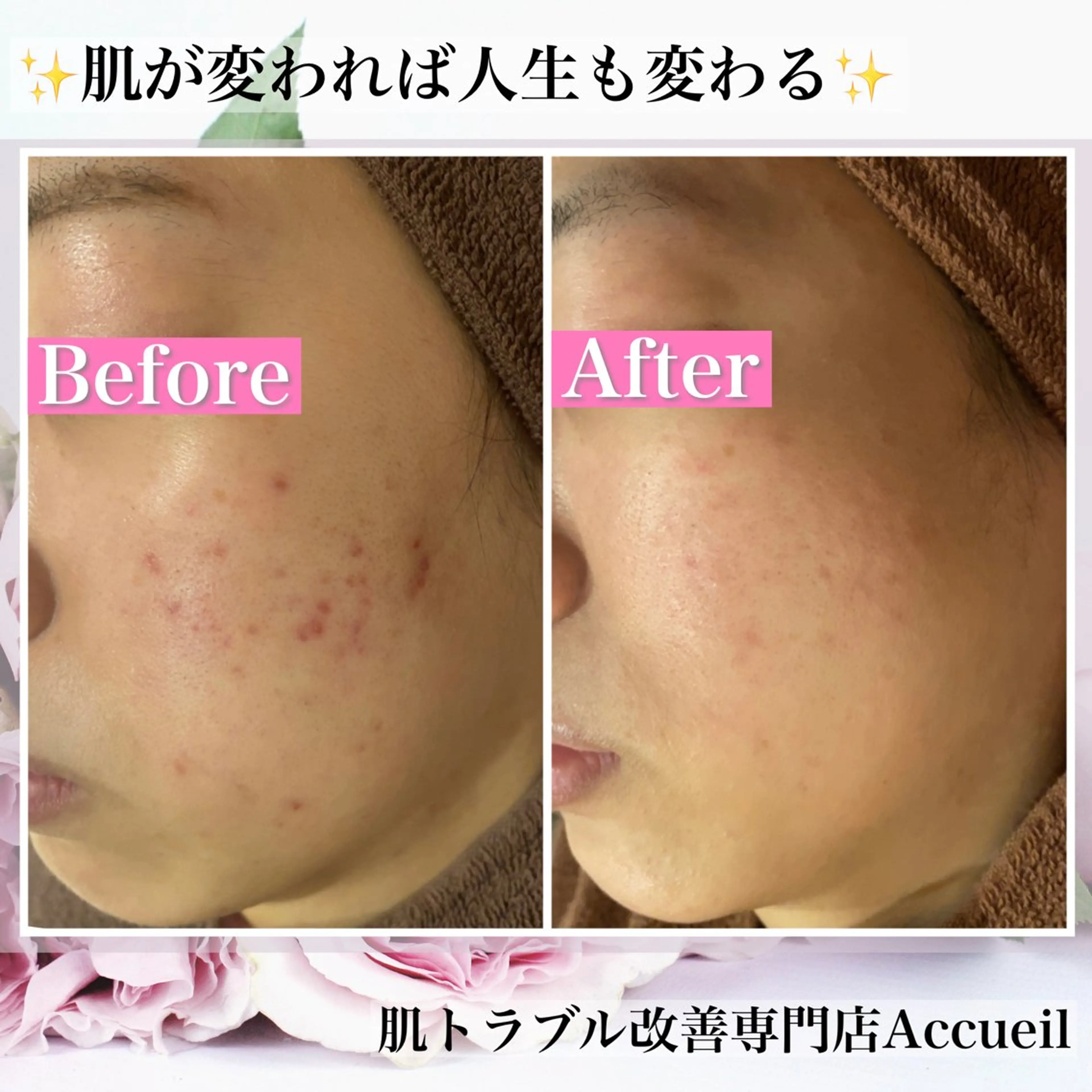 エステ リラク ニキビ・肌質改善専門 ♡人生が変わるサロンのエステ・リラクイメージ