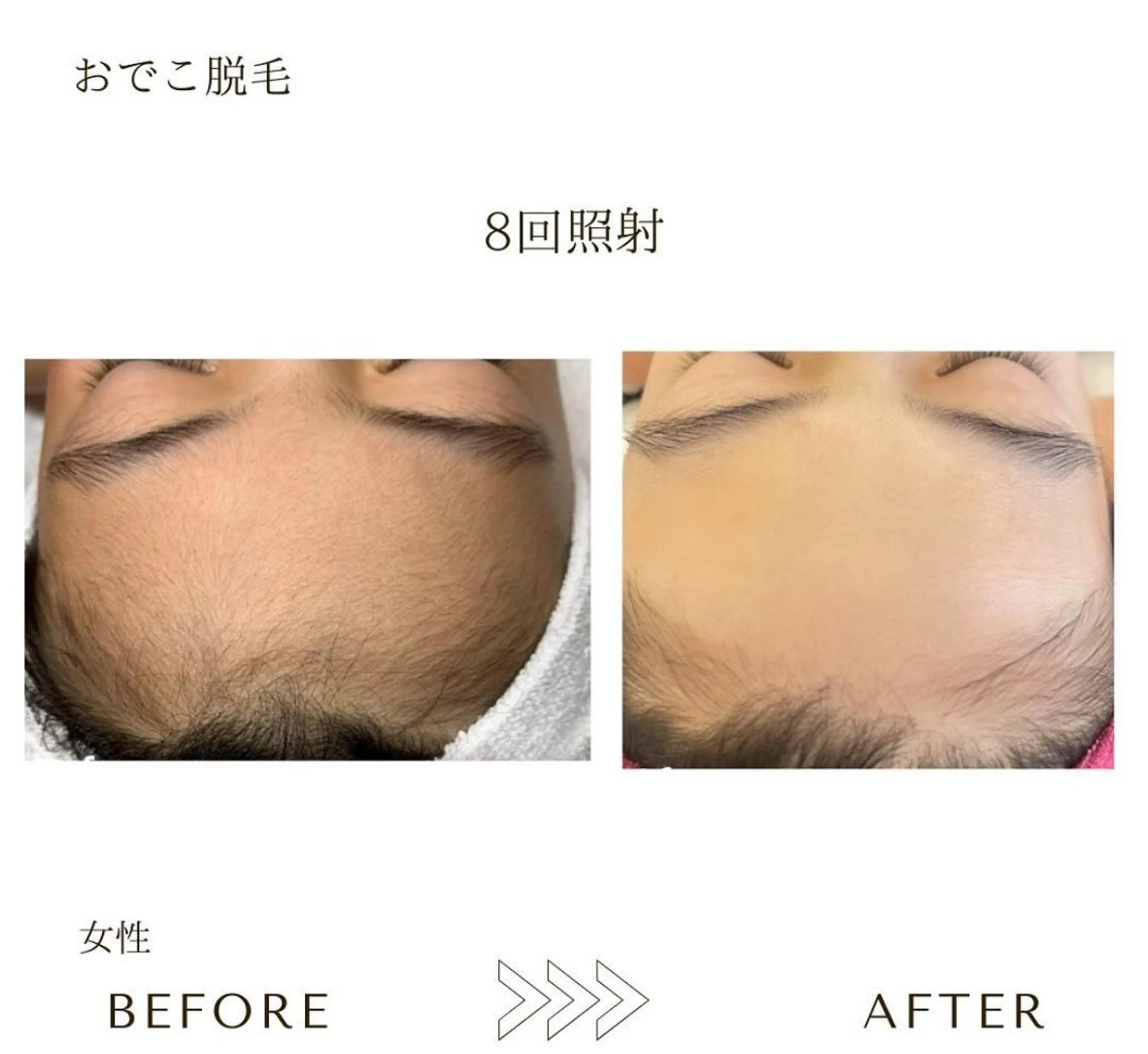 脱毛 本八幡salon83 ♡エイトミーのエステ・リラクイメージ