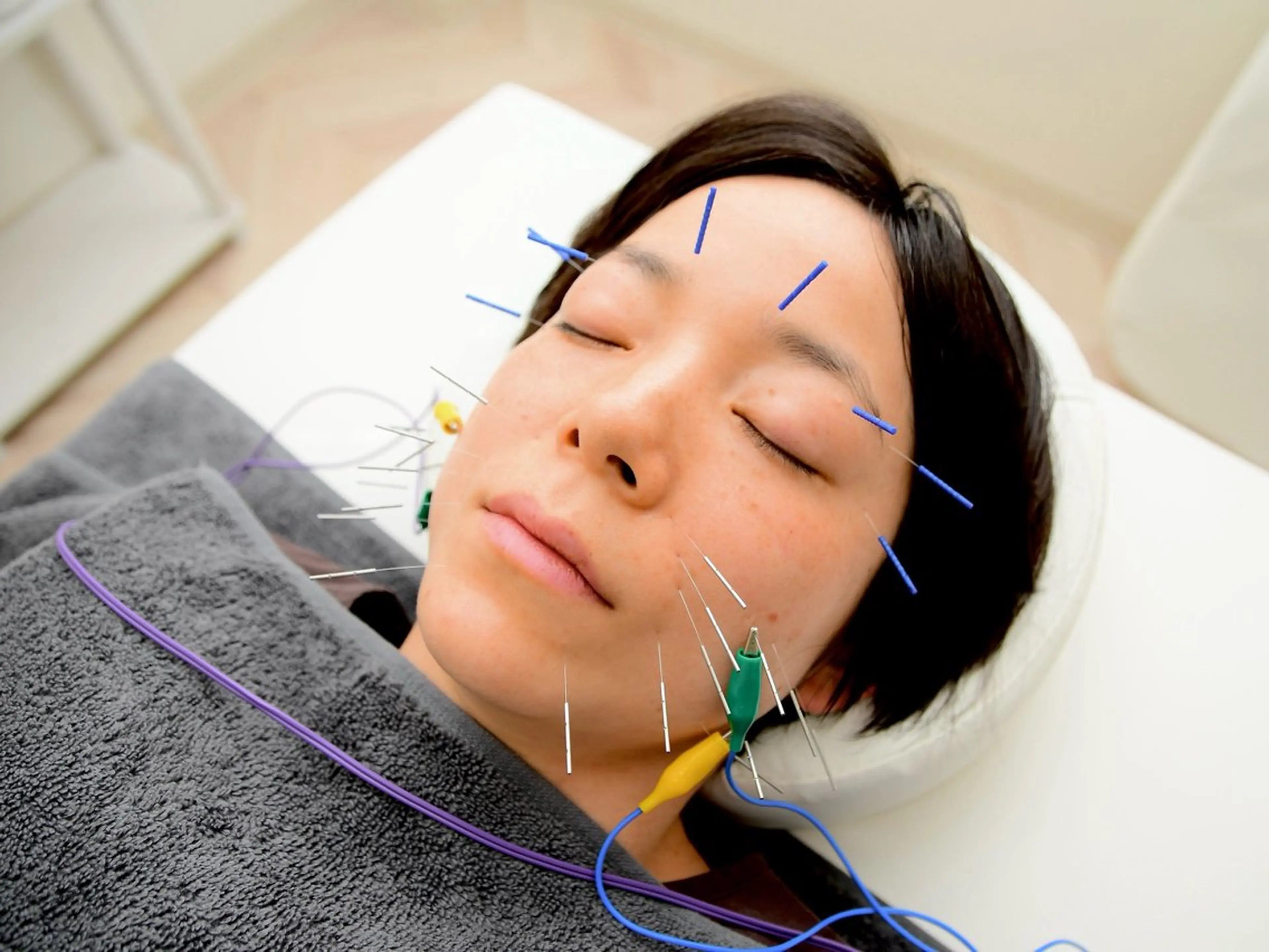 【初回美容鍼】美容鍼灸40分(箱灸付き)の写真