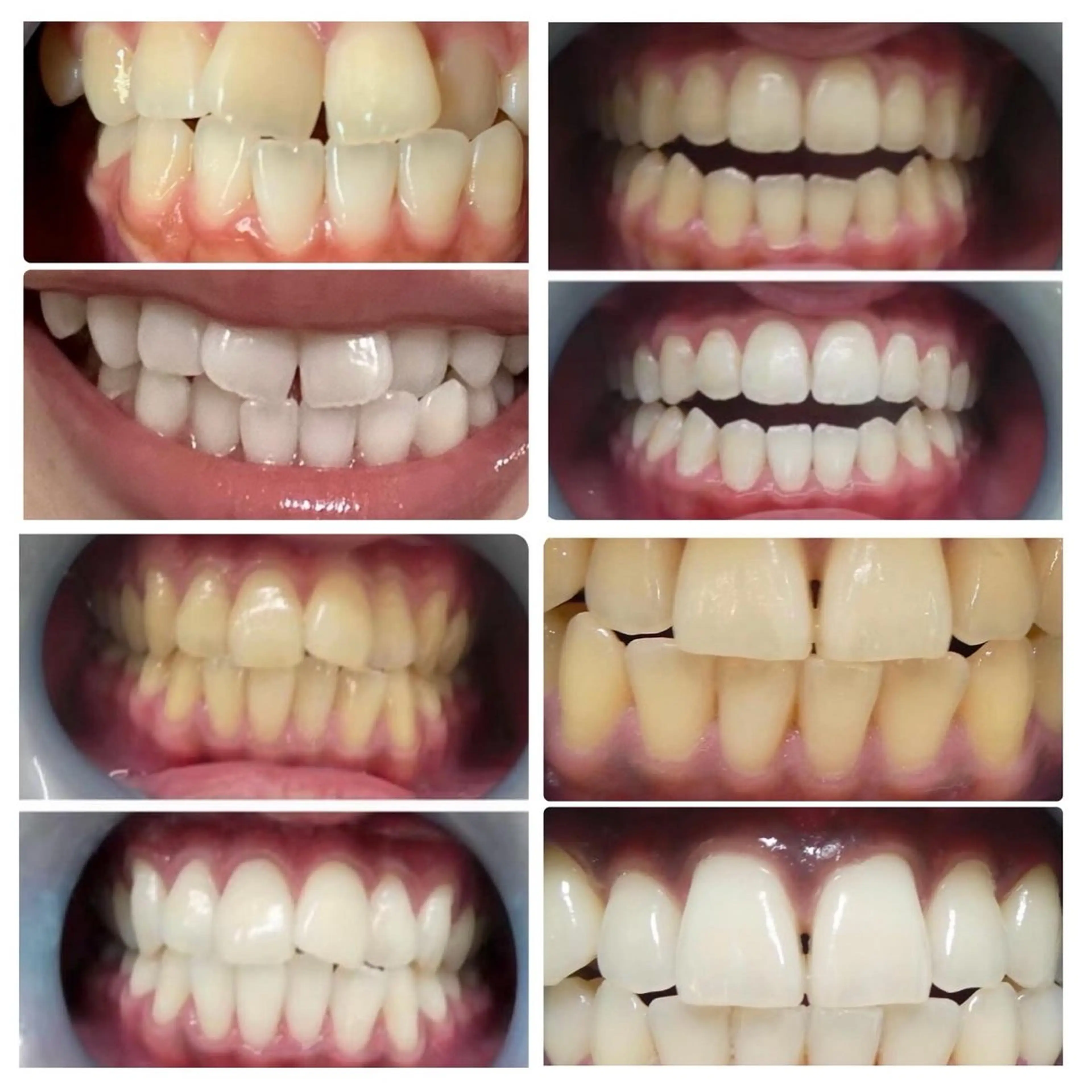 医師による診断・処方の『プレミアムホワイトニング』（メンズ可）の写真