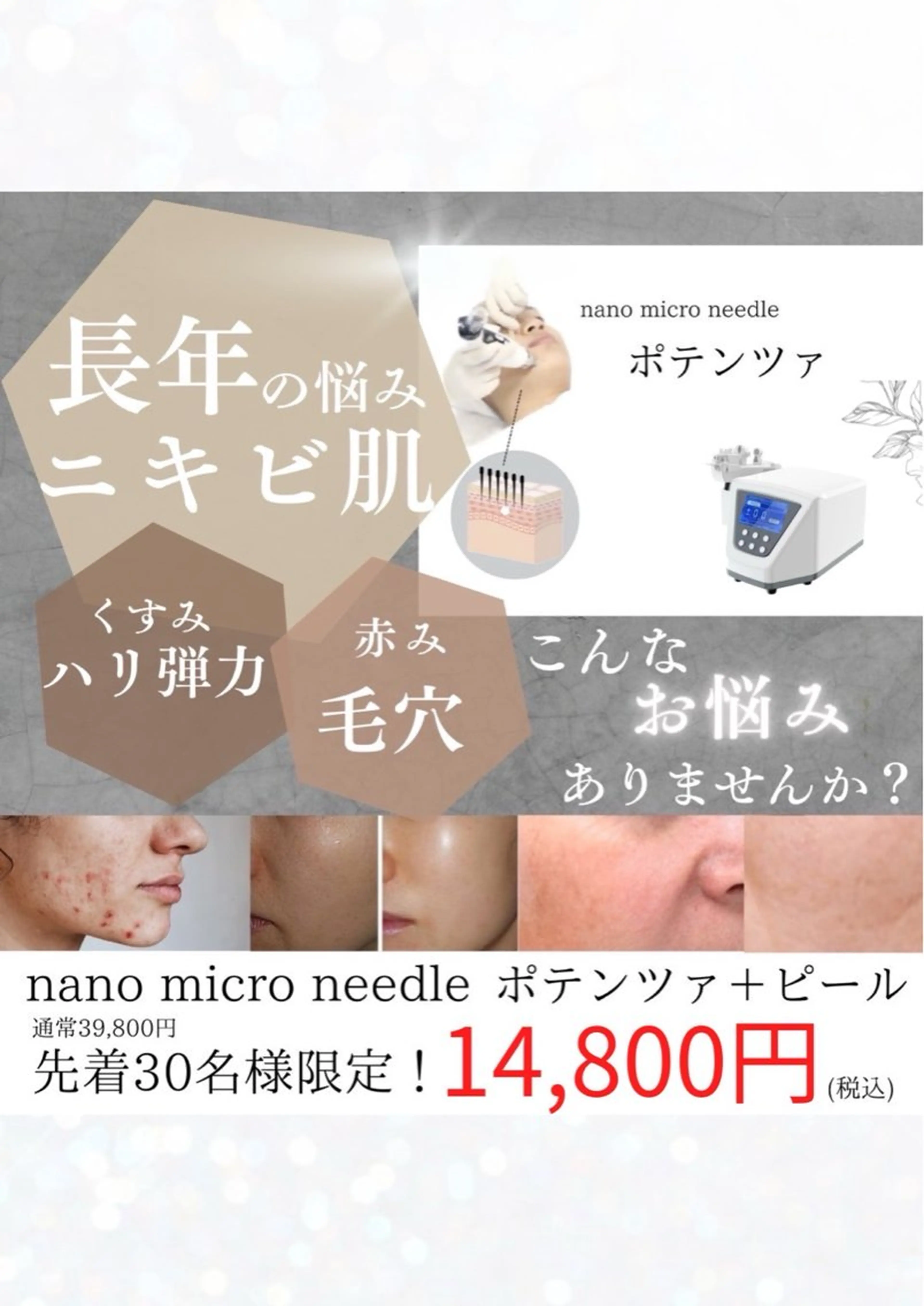 【業界初!】エステ版ポテンツァ&ロイヤルピーリングの写真