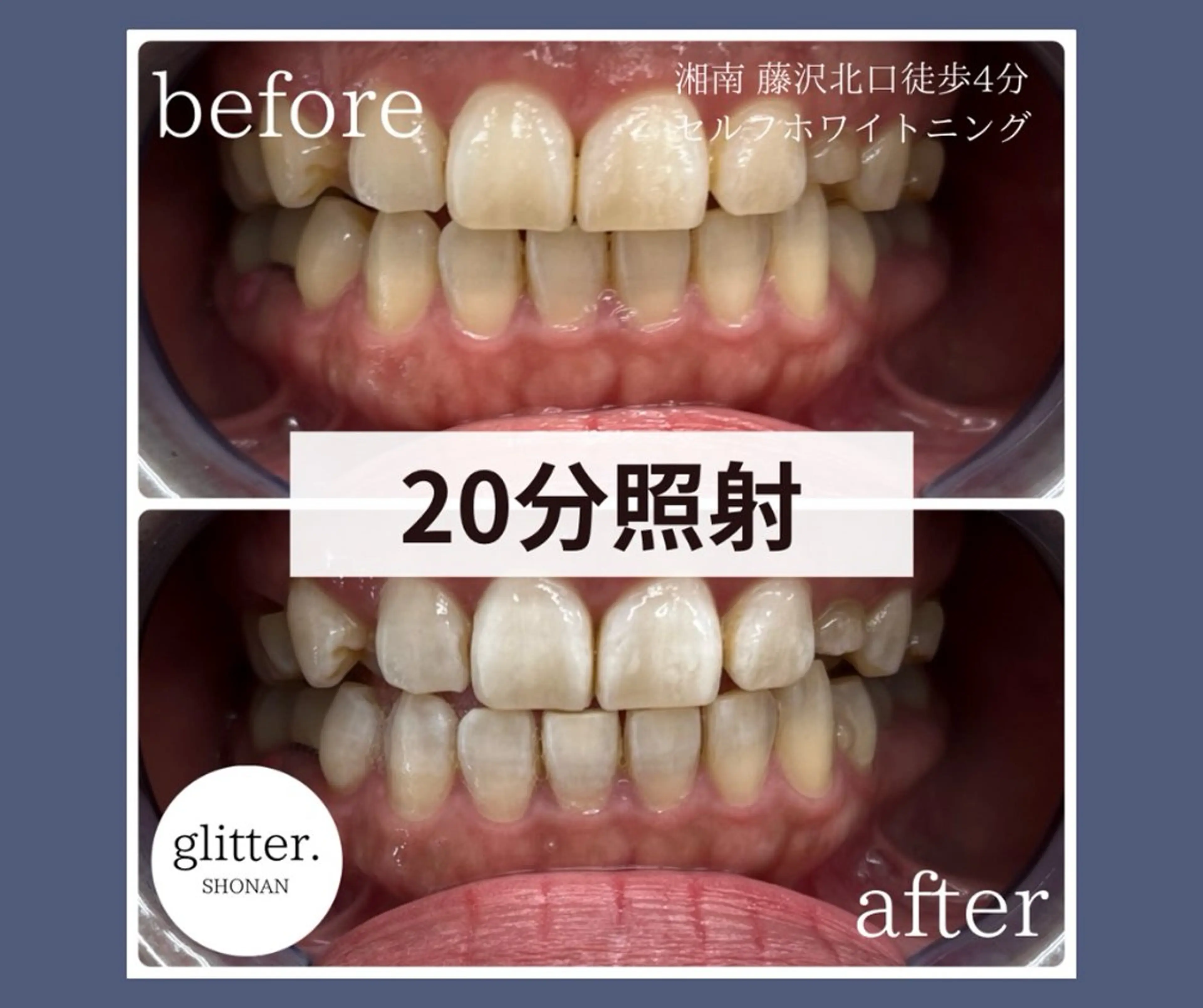 ネイル ホワイト ホワイトニング専門店 glitterのその他イメージ