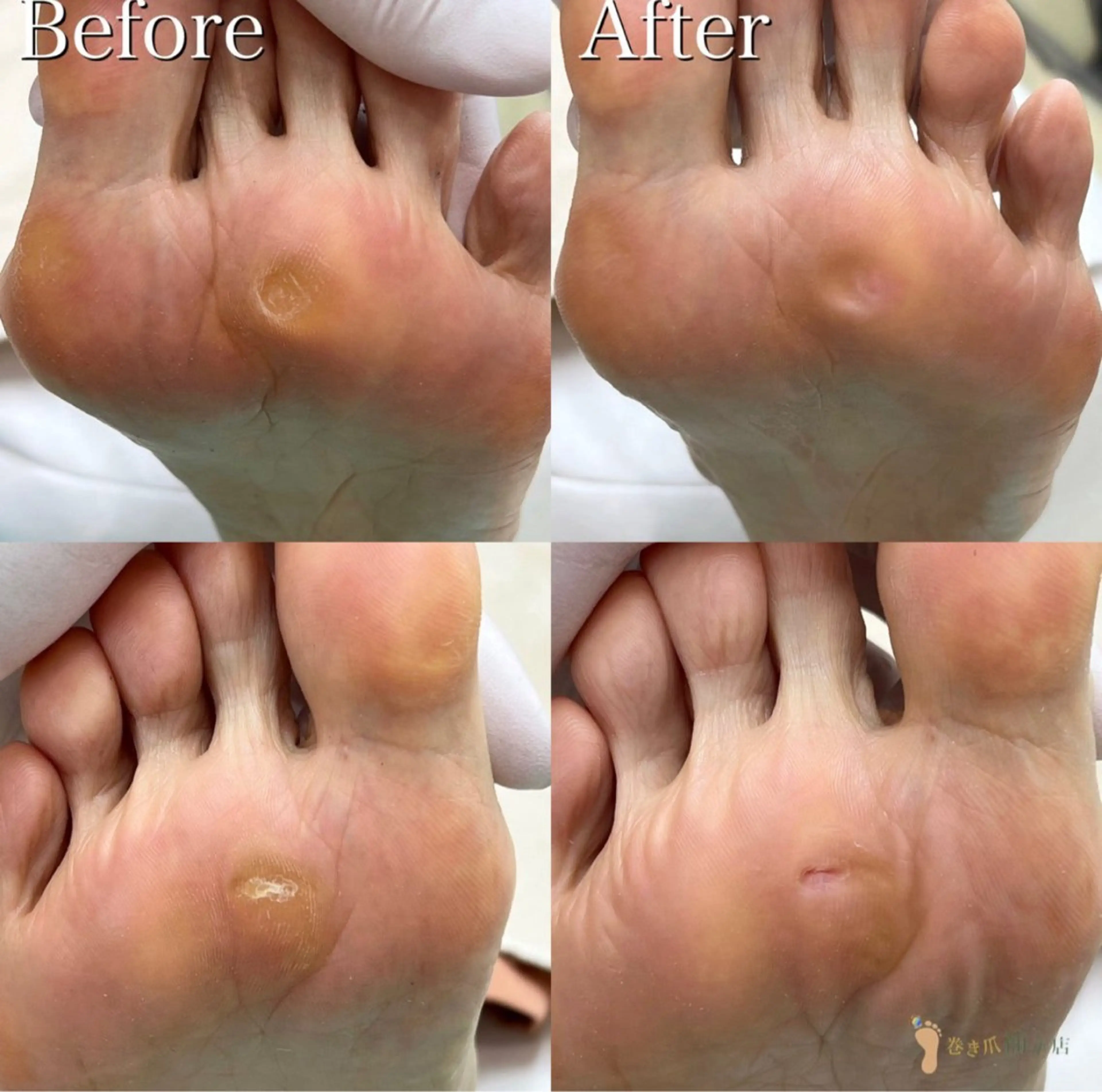 【足裏タコ魚の目ケア】口コミにご協力頂ける方限定⭐︎足裏のかた​〜​い角質も🦶💦いた​〜​い魚の目も😩丁寧に除去します🤗の写真