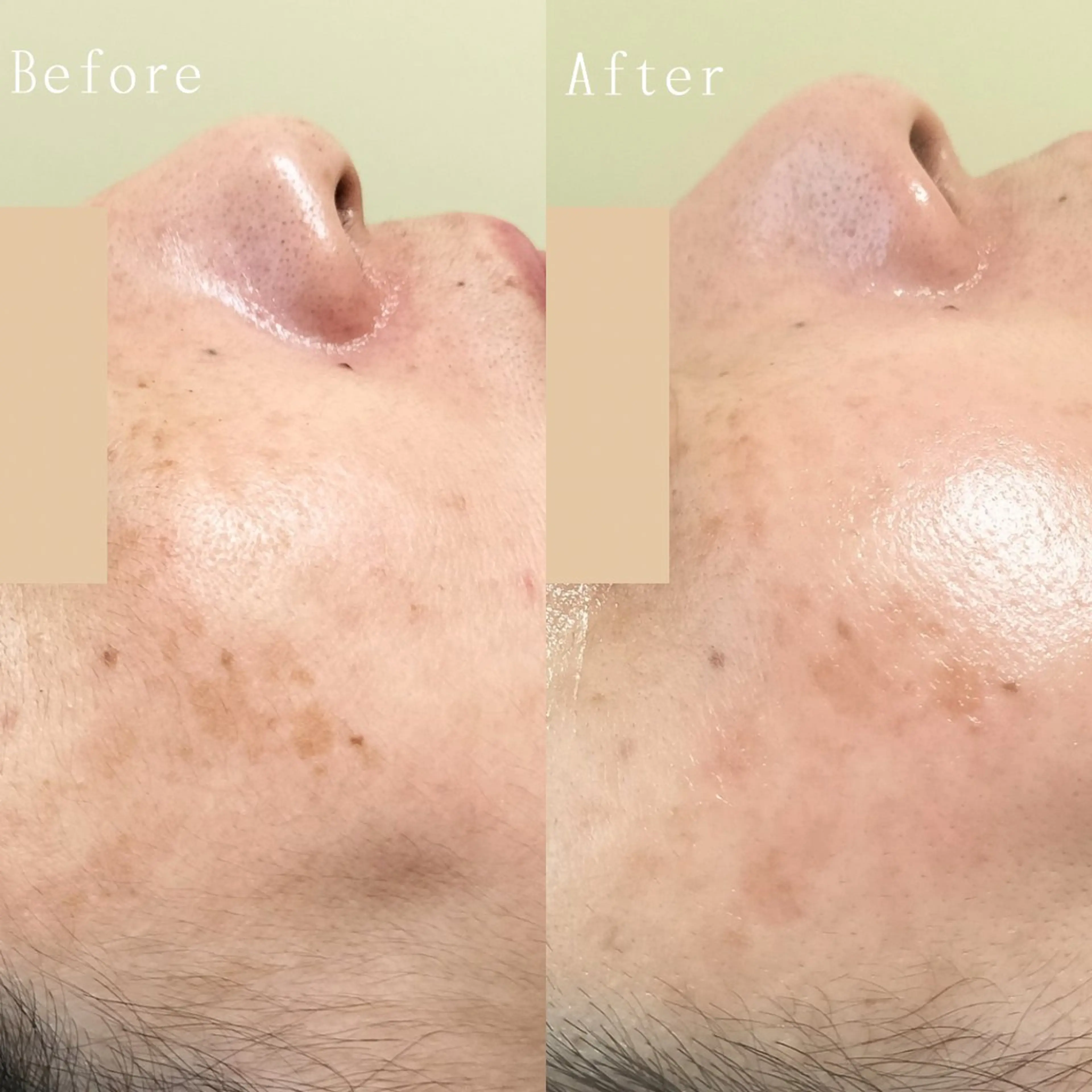 シミケアピーリングの写真