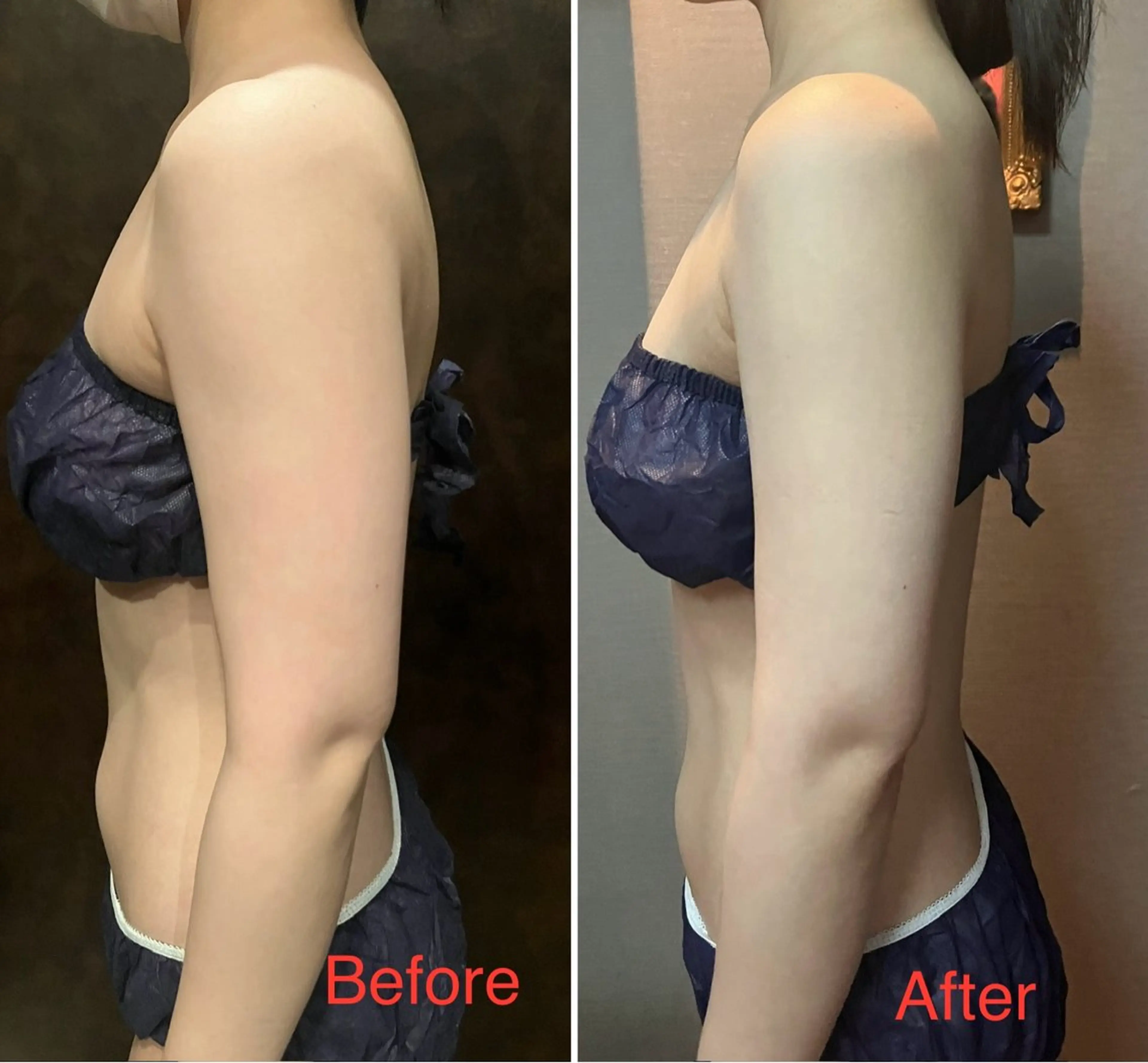 【二の腕集中ケア】60分　今年こそはノースリーブを着たい！そこのあなた！理想の二の腕のへの入り口✨の写真