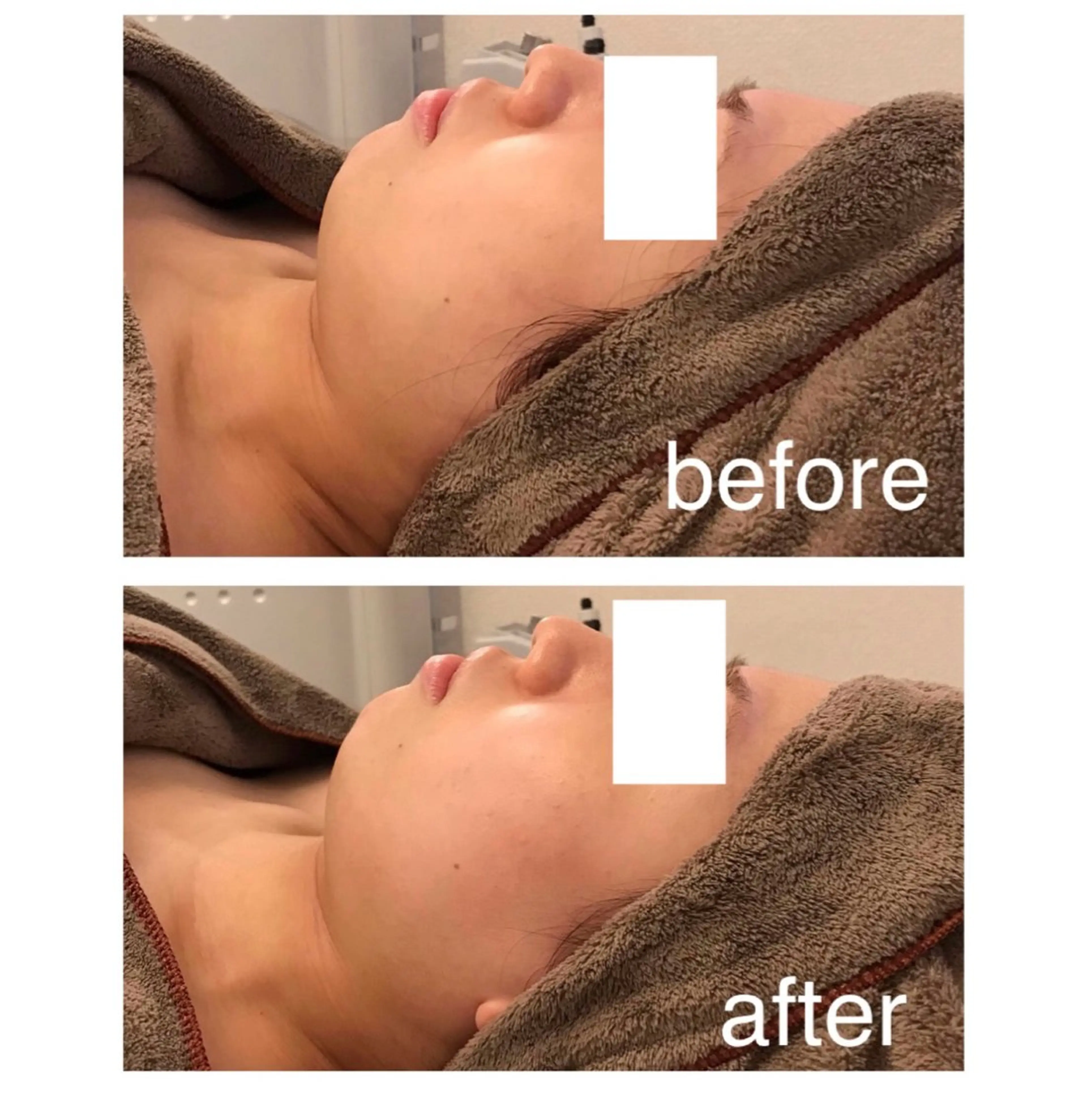 【フェイスラインをくっきり！小顔痩身エステ】EMSとあたためで毛穴の引き締めも叶う✨症例写真モニター募集の写真