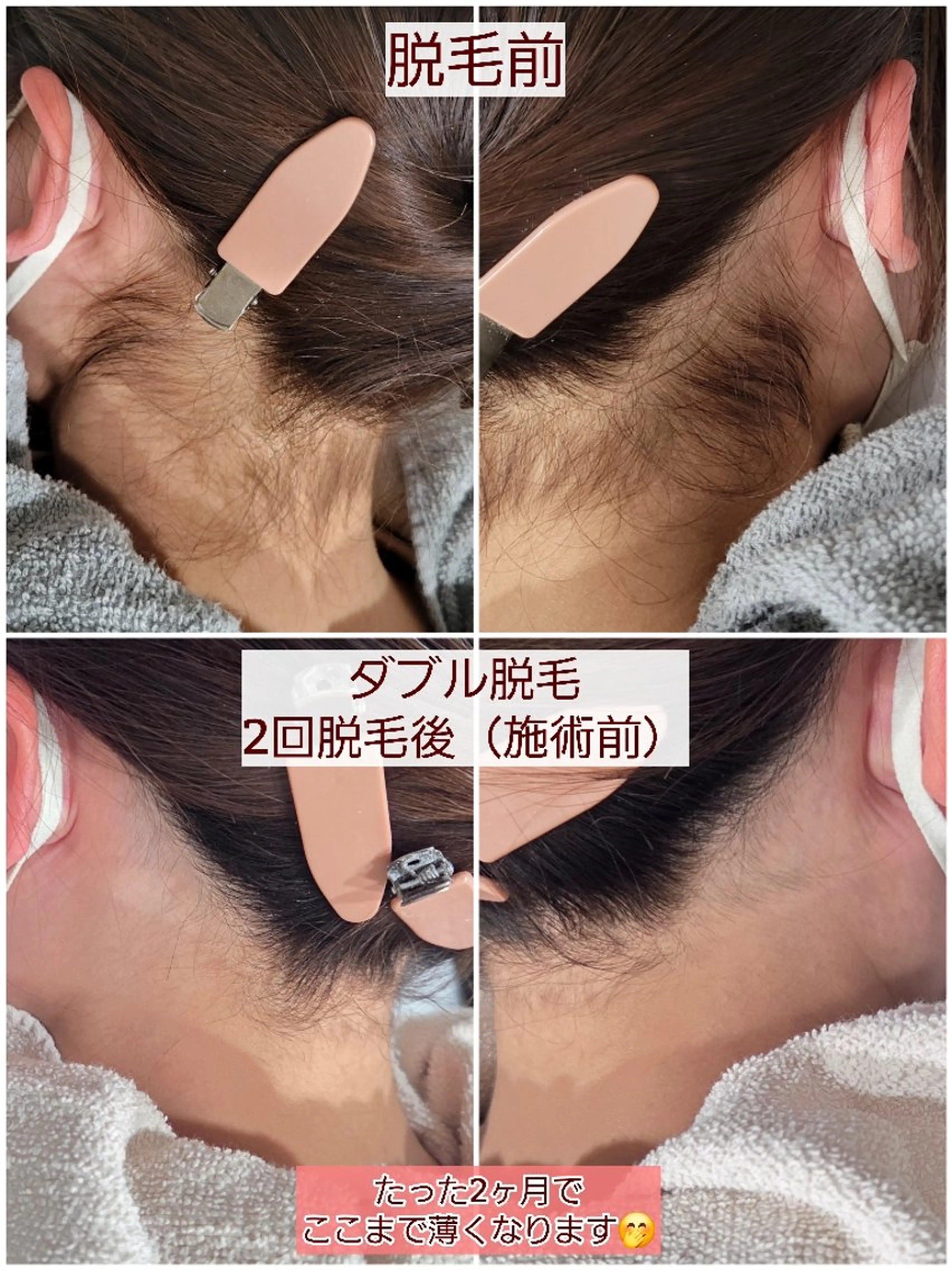 脱毛 A*《エースター》 シュガーリング🍋のエステ・リラクイメージ